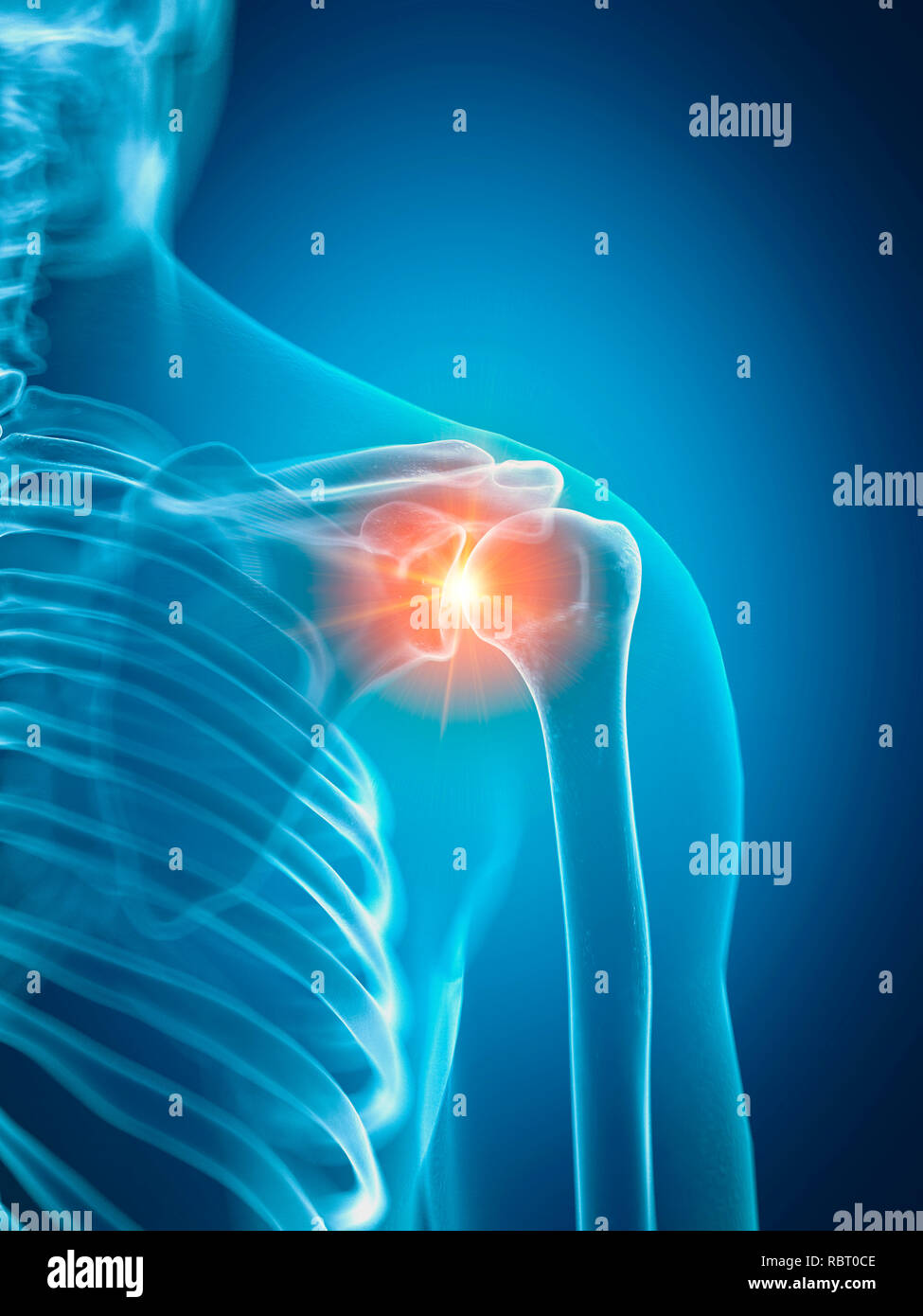 Illustrazione di una spalla dolorosa. Foto Stock