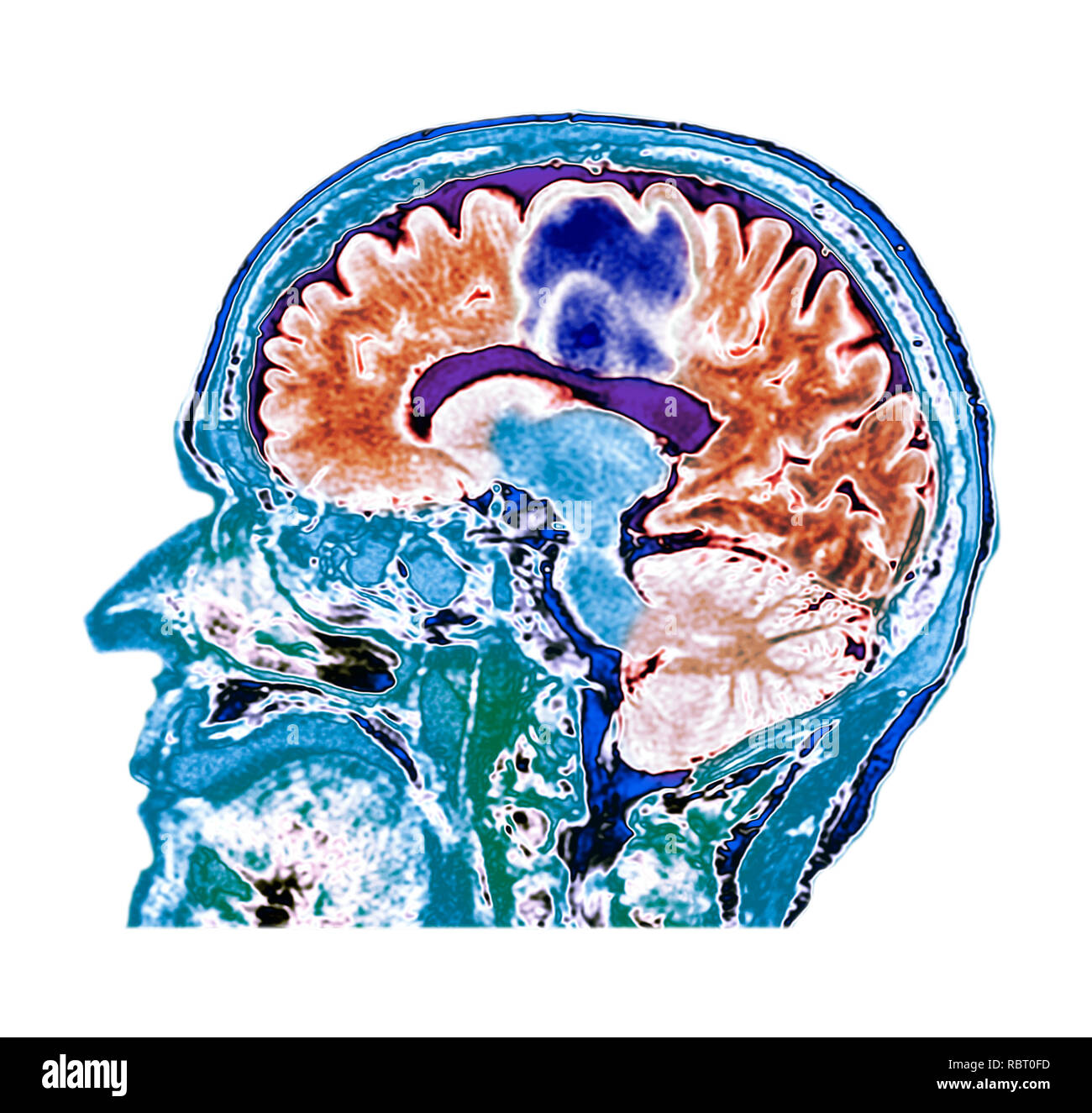 Il glioblastoma cancro al cervello. Colorato la tomografia computerizzata (CT) scansione di una sezione attraverso il cervello di un 84-anno-vecchio paziente femmina con glioblastoma (blu, alto). Il glioblastoma è la più aggressiva forma di cancro al cervello. Il trattamento consiste in chirurgia, dopo di che la chemioterapia e radioterapia sono utilizzati. Tuttavia, il cancro di solito si ripresenta nonostante il trattamento e la maggior lunghezza comune di sopravvivenza dopo la diagnosi è di 12-15 mesi. Senza trattamento, la sopravvivenza è tipicamente di 3 mesi. Foto Stock