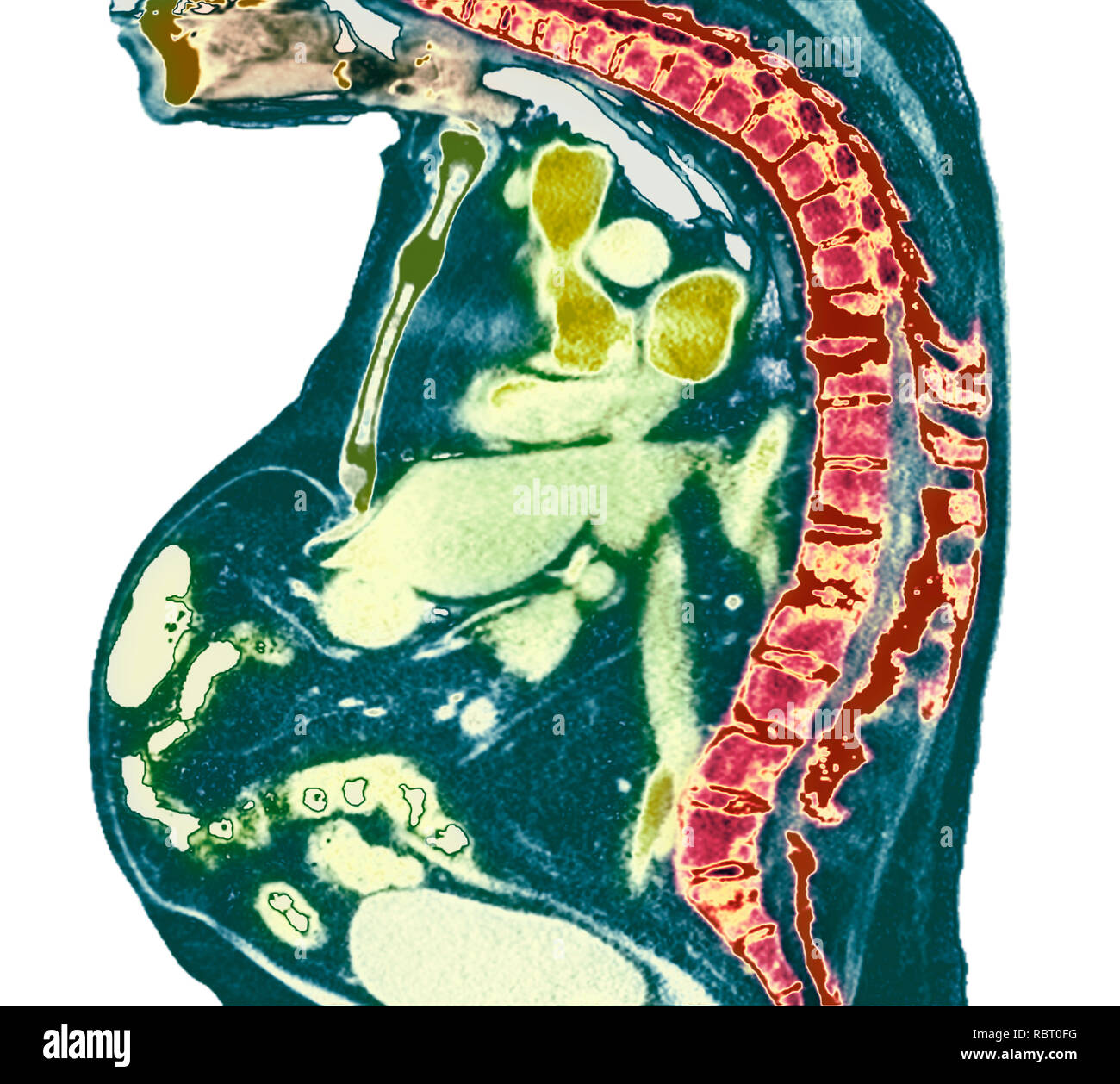 Spina dorsale nella spondilite anchilosante. Colorato X-ray di una sezione attraverso la colonna vertebrale toracica di un 74-anno-vecchio paziente di sesso maschile con spondilite anchilosante, sho Foto Stock