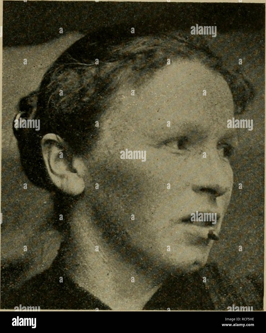 . Die vergleichende Pathologie der Haut. Dermatologia veterinaria; pelle. Hauthörner. 389 Garreau (bei Goubeaux n. 215) sah am rechten Schultergelenk eines Sjährigen Merino- schafs ein un einer herabgezogenen Hautfalte hängendes 22 cm langes, an der base des Hautwulstes 12 cm im Umfang messendesHorngebilde, das aus übereinander geschobenen hohlenKegeln bestand. Die guerra Hornmasse außen ziemlich Hart, die base weich. Die histologische Untersuchung zeigte die Entwicklung aus Hautpapillen mit zu miglior Hornbildung. Figura 108.. Korn der Unterlippe. (Eigene Beobachtung.) Figura 109.. Si prega di notare tha Foto Stock