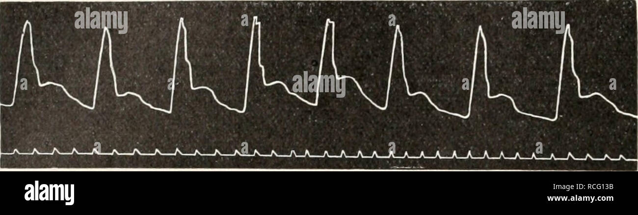 . Die Physiologie des Kreislaufes. Sistema cardiovascolare. 194 die Strömung des Blutes im großen Kreislauf. Marey sehen Sphygmographen II erhalten wurden (Fig. 393), sieht man die eckigen, zitterigen, bei kleiner ampiezza stark abgeflachten Kurven, während die mit dem Sphygmographen v. Il Freys erhaltenen (Fig. 394) im absteigenden Aste mehrere kleine, durch Eigenschwingungen verursachte Diskontinuitäten aufweisen.. Flg. 394. Radialispuls mit dem v. Freyschm Sphygmographen geschrieben. Nach Fetter.. Si prega di notare che queste immagini vengono estratte dalla pagina sottoposta a scansione di immagini che possono essere state digitalmente Foto Stock