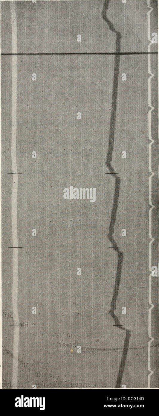 . Die Physiologie des Kreislaufes. Sistema cardiovascolare. Die Eigenschaften der Gefäßwand un und für sich. 61 der Arterien waren, sind nach Hürthle durch Physikalisch perché-chemische veranlaßt Ursachen und gehören vermutlich in das capitolo Gebiet elektro-osmotischer Erscheinungen. Nähere Aufschlüsse hier- über hat dann Blumenfeldt^ mitgeteilt. Die Strönmng vondestil- liertem Wasser durch enge Glasröhren ruft elektrische Ströme sowohl bei konstan- tem als bei intermittierendem Zufluß hervor. Dasselbe ist auch bei getrockneten und Wochen- bis monatelang auf- bewahrten und dann wieder erweichten Arterien der F Foto Stock