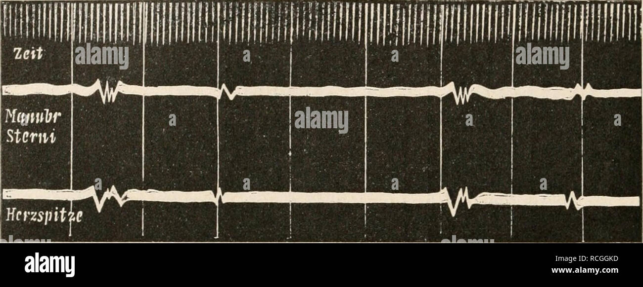 . Die Physiologie des Kreislaufes. Sistema cardiovascolare. 72 Die mechanischen Leistungen des Herzens. Auch A. Weber und A. Wirth'^ finden, dass die Herztöne, obgleich sie auskultierenden dem Ohr vollkommen überall gleich sind und sich nur durch ihre ver- schiedene Lautheit unterscheiden, dennoch ein ganz verschiedenes Aussehen haben, je nachdem sie von der Herzbasis oder der Herzspitze aufgenommen werden (vgl, Fig. 37). Dagegen gibt Gerhartz un, dass die Höhe des ersten wie des zweiten Herz- toni an den verschiedenen Auskultationsstellen etwa dieselbe ist.^ Die großen Variationen, welche anche io Foto Stock