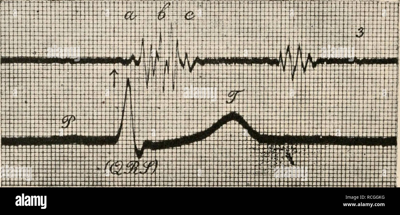 . Die Physiologie des Kreislaufes. Sistema cardiovascolare. Fig. 35. Herzstoßkurve vom Menschen mit daran super- ponierten Herztönen, Nach Edens.^ Von links nach rechts zu lesen.. Fig. 36. Spitzenstoß und Elektrokardiogramm vom Menschen. Nach Battaerd. a, b, c, Anfangs-, Haupt- und Endschwingungen des ersten Herztones; oberhalb P die Schwingungen des Vorhof- toni; 3, der dritte Herzton. Von links nach rechts zu lesen. Eine nähere akustische analizzare der Herztöne ist von Gerhartz und Roos ver- sucht worden und zwar haben sie dabei vor allem die Tonhöhe des Grundtons, Weiß außerdem noch die der T Foto Stock