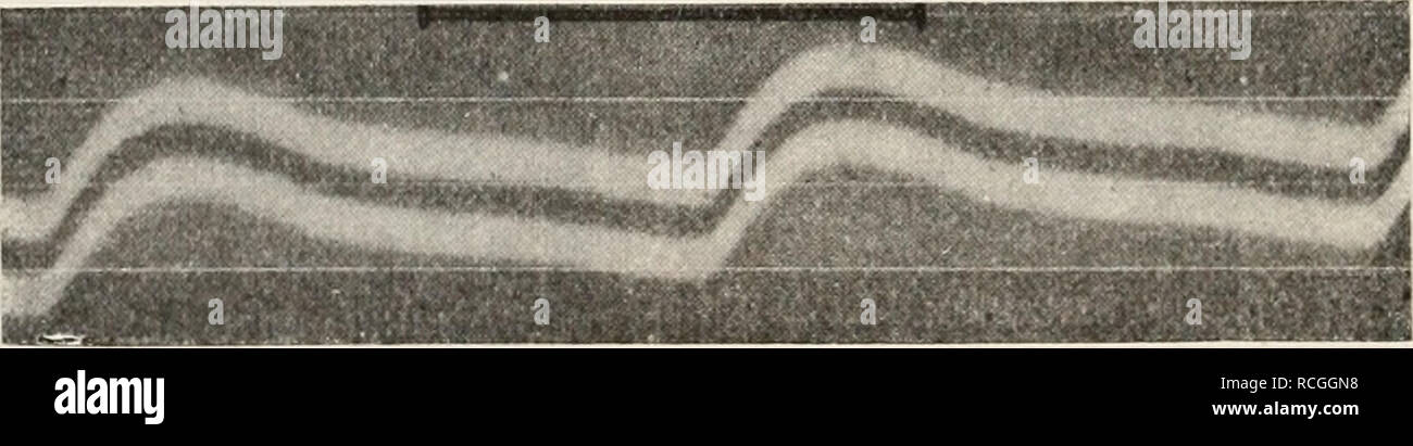 . Die Physiologie des Kreislaufes. Sistema cardiovascolare. Fig. 425. Puls einer Mesenterialarterie. Nach C. Tigerstedt. Von links nach rechts zu lesen. Im Puls der Mesenterialarterien tretenj die superponierten in Wellen, Belgium.Wellen in der Regel nur ganz undeutlich auf, obgleich daselbst Ab und zu, Insbesondere nach adrenalina, Andeutungen von solchen vorkommen. Beim Kaninchen gibt morire anche formare des impulsi in den peripheren Gefäßen wesentlich die des zentralen impulsi wieder; nur wird das systolische Altopiano in den peripheren Gefäßen immer mehr absteigend und die für den zentralen Puls così charakteristischen sup Foto Stock