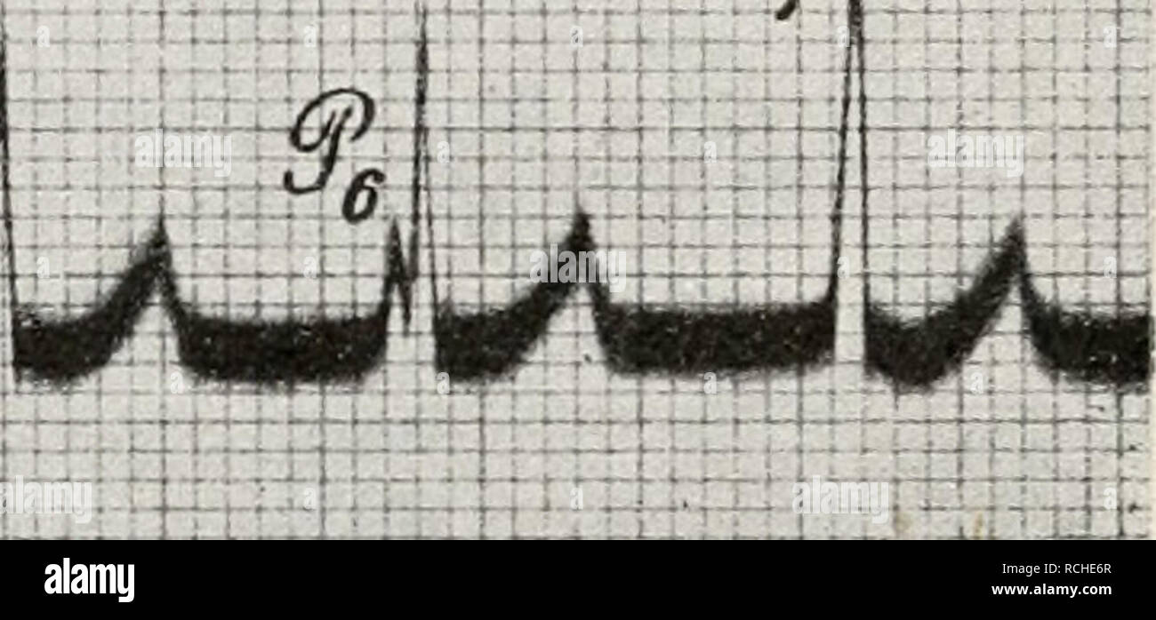 . Die Physiologie des Kreislaufes. Sistema cardiovascolare. • ( W 11. Fig. 322. Elektrokardiogramm vom Hunde nach Vergiftung mit Morphin. Nach Einthoven. Vollständige Dissoziation zwischen Vorhöfen und Kammern. Fig. 322 stellt das Elektrokardiogramm bei blocco vollständigem dar, welcher durch eine Hemmung in der Leitung zwischen Vorhöfen und Kammern statt- gefunden hat. Die gegenseitige Verschiebung zwischen der Zacke P und Kammerelektrokardiogramm dem kommt sehr deutlich zum Vorschein. Bei P1 caduti die Vorhofzacke und die /?-Zacke der Kammer genau zusammen. In Fig. 323 ist ein vollständiger blo Foto Stock