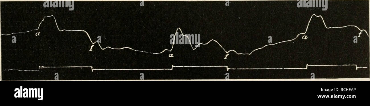 . Die Physiologie des Kreislaufes. Sistema cardiovascolare. Fig. 127-130. Verschiedene Formen des Kardiogrammes bei herzgesunden Menschen. Nach Edgren. Es ist nicht ganz unmöglich, dass diese Verschiedenheit auf eine verschiedene Lage des Herzens in bezug auf die Brustwand bedingt ist denn Pachon^ hat an- gegeben, dass bei allen von ihm untersuchten das Individuen Kardiogramm, Wenn nur die Versuchsperson auf der linken Seite liegt, konstant das in der Fig. 131 dar- gestellte Aussehen, d. h. dieselbe forma, wie das vom Pferdeherzen direkt auf- 1, Edgren Skand. Arch. f. Physiol., 1, S. 85; 1889. 2 V Foto Stock