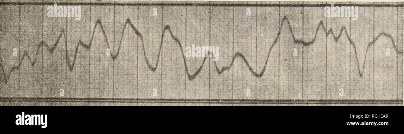 . Die Physiologie des Kreislaufes. Sistema cardiovascolare. Die elektrischen Erscheinungen am Herzen. 271 Auch bei Aktionsstrom dem kann nach einer Extrareizung die verlängerte pausa sowie die Zunahme der Postextrasystole beobachtet werden (Samojloff1). Ferner folgt aus der Registrierung des Aktionsstromes (beim Froschherzen), dass das intervallo zwischen den Vorhof- und Kammerkontraktionen im Vergleich mit dem normalen Verhalten des Herzens bei der Extrasystole verlängert, bei der nach der folgenden pausa sistole verkürzt aber ist (de Boer2). Desgleichen findet de Boer3, unter der Voraussetzung, Foto Stock