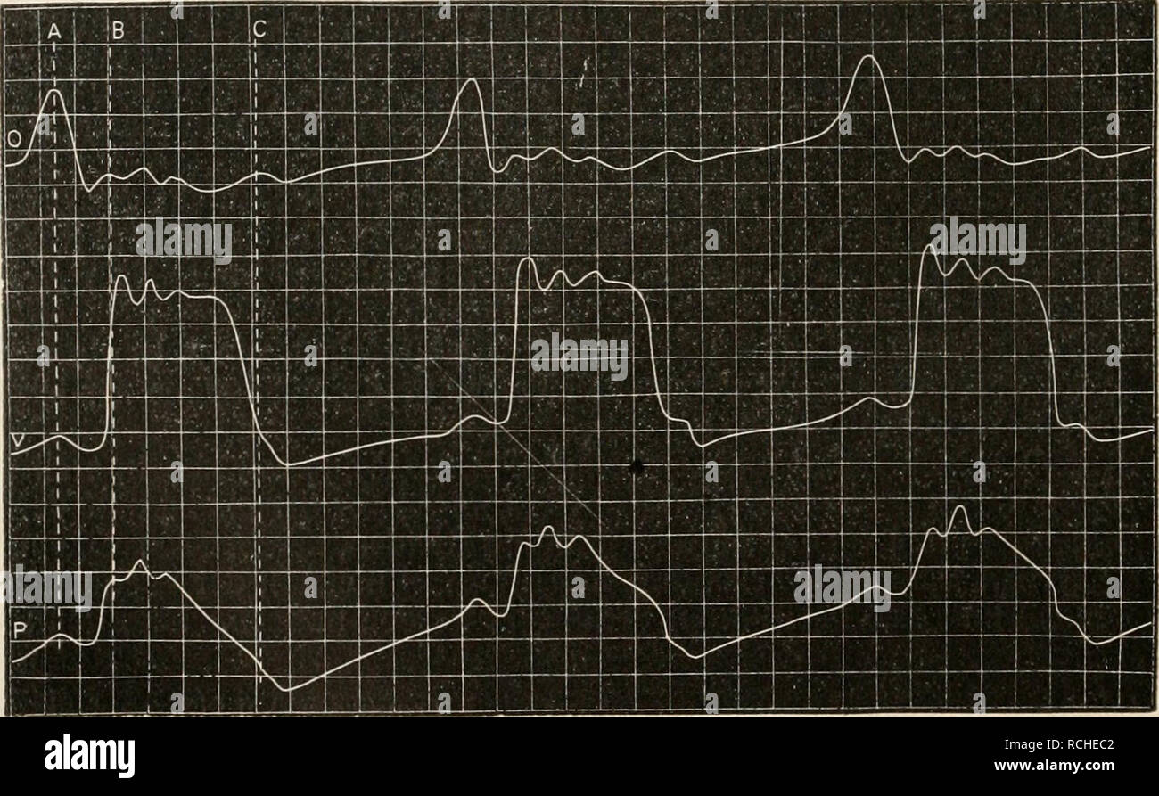 . Die Physiologie des Kreislaufes. Sistema cardiovascolare. 158 Die mechanischen Leistungen des Herzens. der Verschiebung der Herzbasis gegen die Spitze beitragen, braucht aber keineswegs zu bewirken, dass die Spitze des sich kontrahierenden Herzens nach unten herabrückt. In modo viel ist jedenfalls sichergestellt, dass die Spitze wenigstens nicht bei allen Tieren nach unten ge- zogen wird, im Gegenteil geht Sie ein klein wenig nach oben und wird nach rechts gedreht (vgl. S. 89, 91). Auch gegen die Auffassung Kornitzers^, dass der Herzstoß von dem Verlauf Spiralen der Aorta und der Lungenarterie bedingt Foto Stock