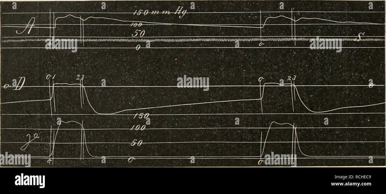 . Die Physiologie des Kreislaufes. Sistema cardiovascolare. 150 Die mechanischen Leistungen des Herzens. erscheint er in der Regel um in modo früher, je steiler die Drucksteigerung in der Kammer am Ende des Anstiegs primären erfolgt. Die Zeit von der Eröffnung der Semilunar- klappen bis zum Gipfel der Anfangsschwingung beträgt nach C. Tigerstedt beim Kaninchenherzen in der Kammer 0,005-0,010 und in der Aorta 0,009-0,014 Sek.i Die Anfangsschwingung kann einzeln sein, es kommt aber in der Regel vor, dass solche mehrere Schwingungen auf den ersten Teil des altipiani superponiert sind.^ Es kann aber auch, Foto Stock