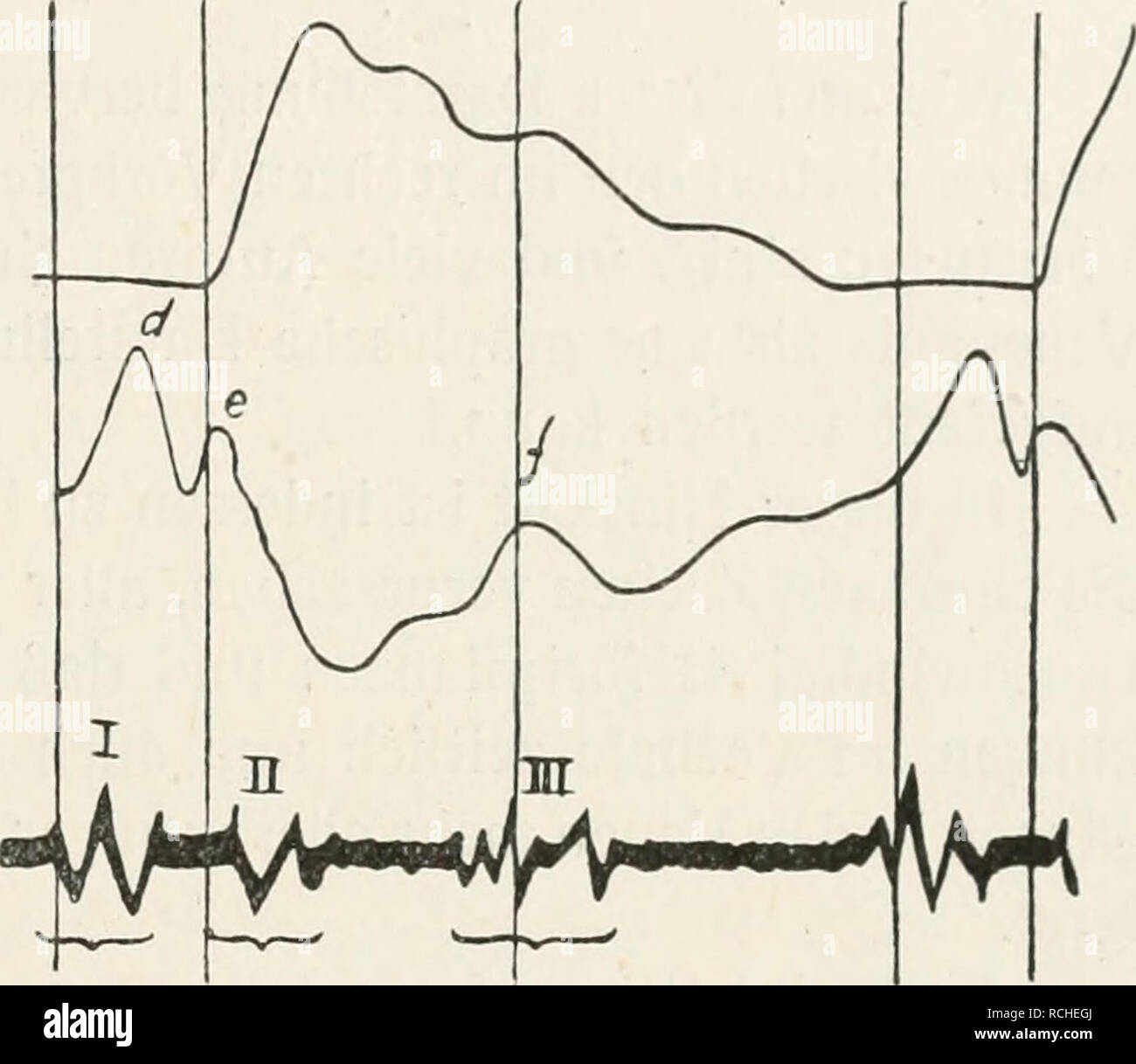 . Die Physiologie des Kreislaufes. Sistema cardiovascolare. Die Strömung des Blutes in den Venen. 319 die Strömung des venösen Blutes herabgesetzt. Auch bleibt sie nach Eröffnen des Brustkastens bestehen.^ Zur Deutung der Senkung h bemerkte Fredericq^, dass hier eine Ansaugung wegen des Herabgehens der atrio-ventrikularen Scheidewand und des ballistischen Rückstoßes des Herzens beim Heraustreiben des Blutes aus den Kammern vor- liegt und dieser Auffassung schlössen sich dann mit einer mehr oder weniger übereinstimmenden Ausdrucksweise Bard^, Wenckebacli^, Mackenzie Rauten- berf und Ewing'' un. Foto Stock