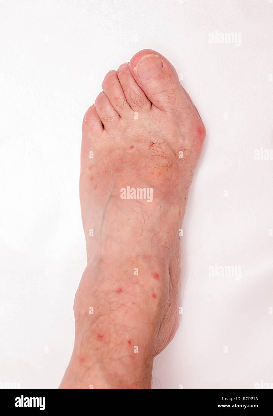 Piede di un uomo con stadio avanzato bunion (abductus alluce valgo) Foto Stock