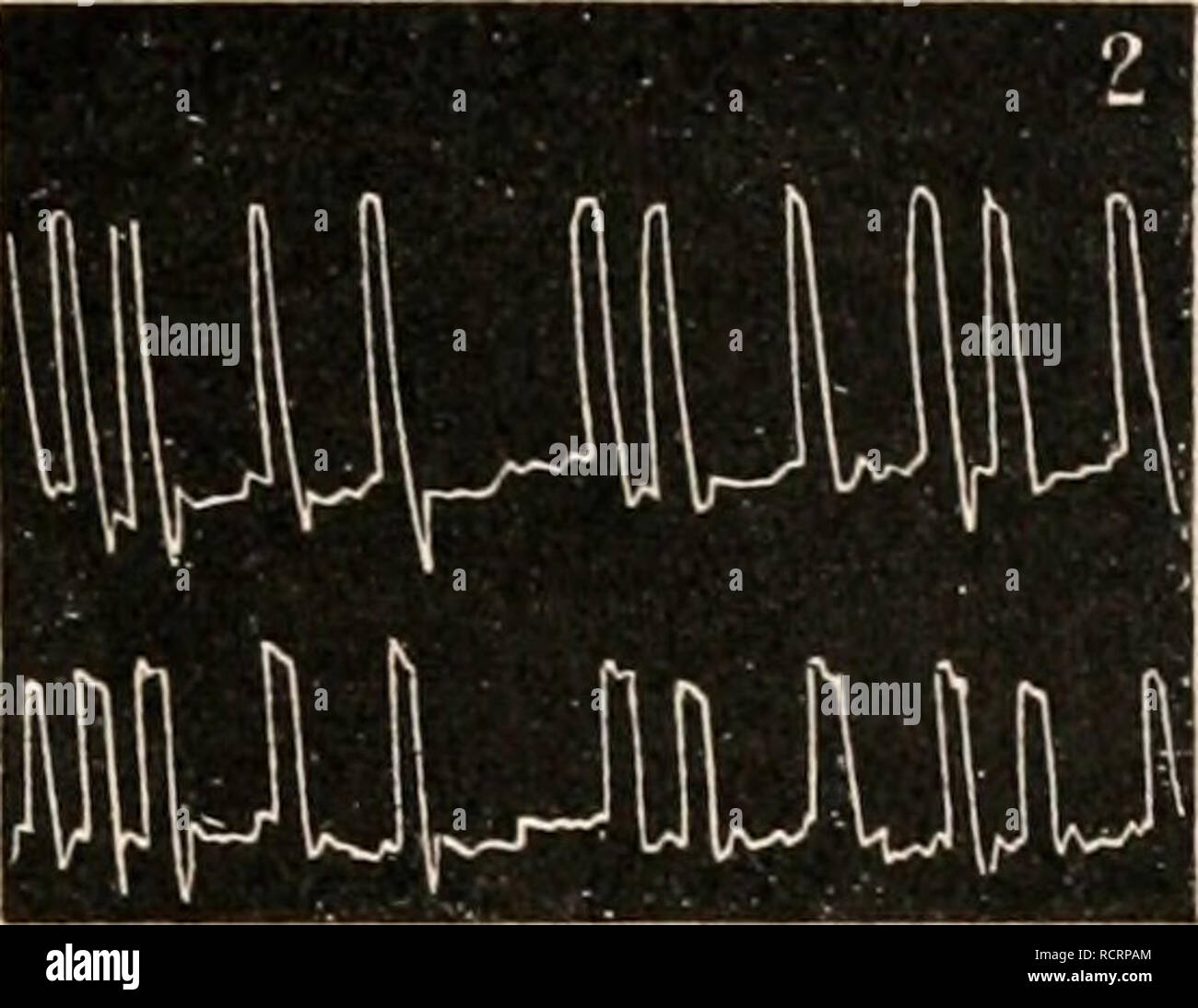 . Dictionnaire de physiologie. Fisiologia. DIGITALE. 27 Puis, apparaÃ®t la fase d'arythmie digitalinique laquelle pendente su osservare onu ventriculaire asynchronisme'evidente : une seule artÃ pulsazione©rielle corrispondono Ã deux pulsazioni cardiaques, d'oÃ¹ l'hypothÃ¨se de l'hÃ©niisystole du ventricule droit. C'est lÃ une interprÃ©tazione inexacte, le synchronisme est toujours absolu et les deux ventricules ne Piv.g. liiiiff. Wl^MW- JUU   lllllll , fillUi' WUil lu ^ujj'uyyyuL^ im m ÃSiiii'iiiiiiii/ho Pl^v.d. Â"â liiiiÃÂ!". Si prega di notare che queste immagini vengono estratte dalla pagina sottoposta a scansione immagini che m Foto Stock