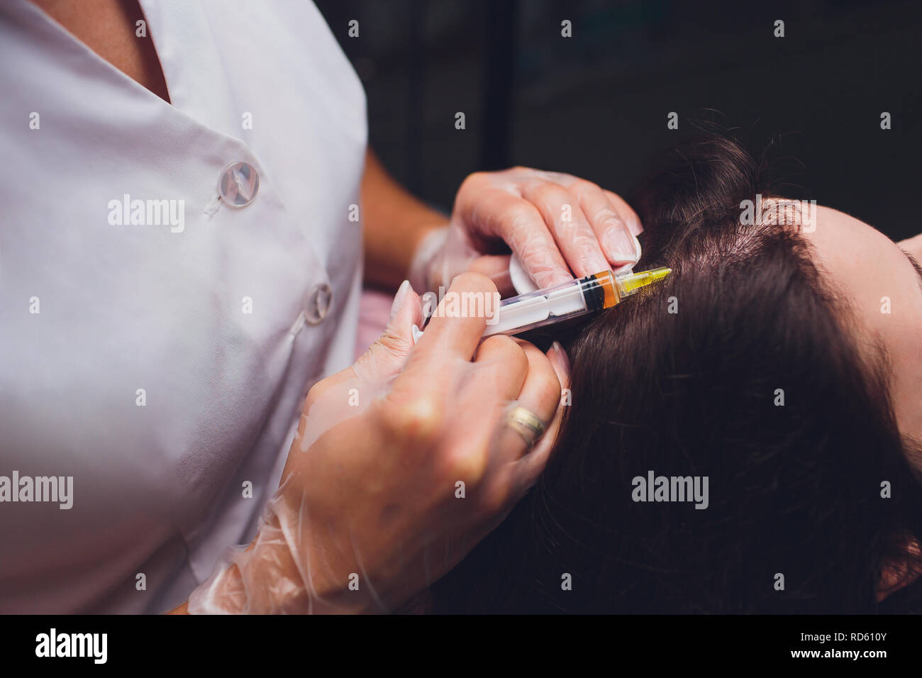 Il plasma ricco di piastrine procedura di iniezione. La crescita dei capelli stimolazione. La terapia con PRP processo. Foto Stock