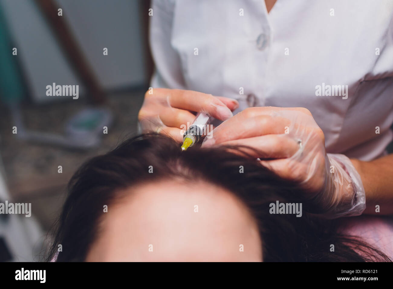 Il plasma ricco di piastrine procedura di iniezione. La crescita dei capelli stimolazione. La terapia con PRP processo. Foto Stock