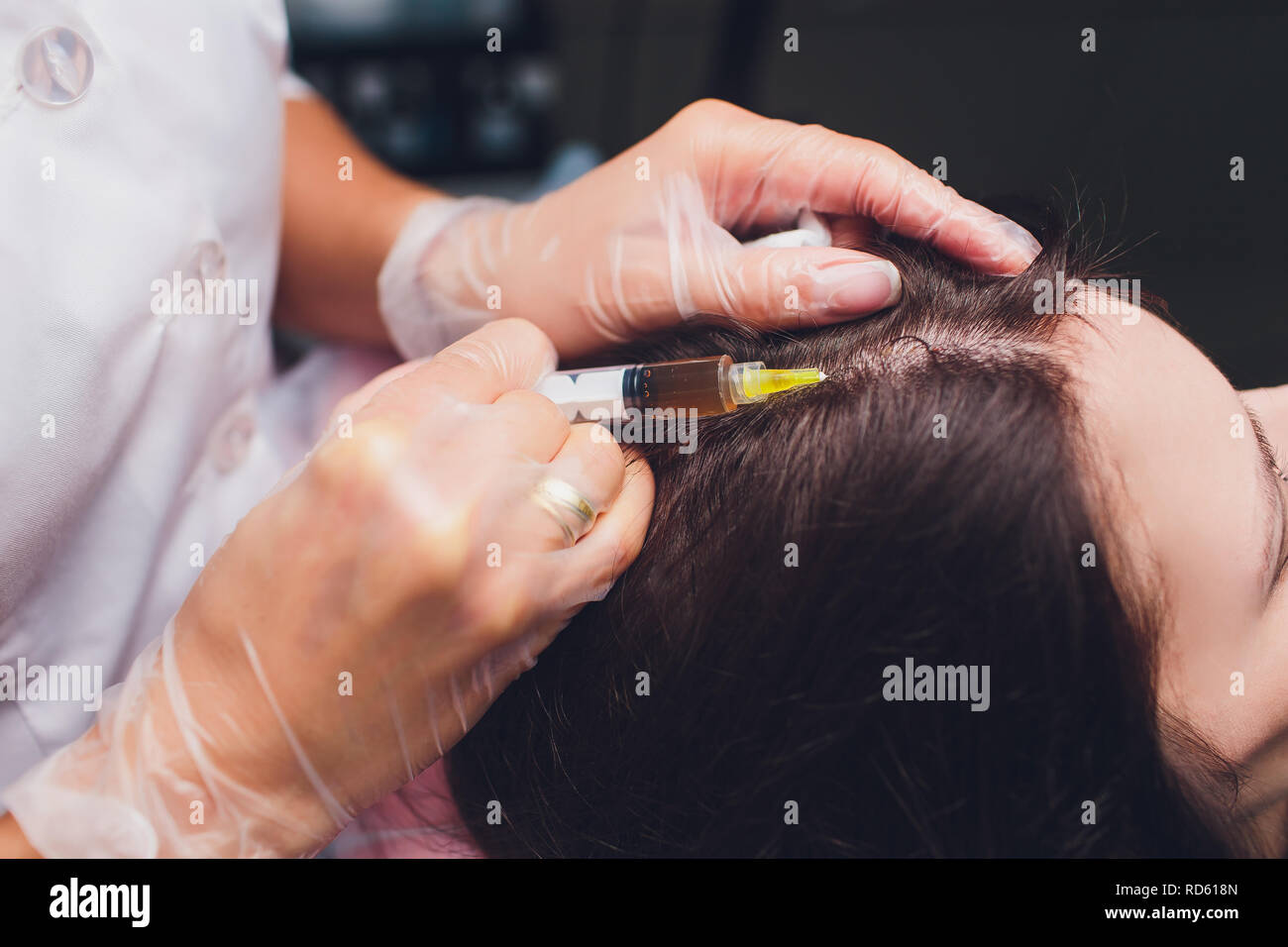 Il plasma ricco di piastrine procedura di iniezione. La crescita dei capelli stimolazione. La terapia con PRP processo. Foto Stock