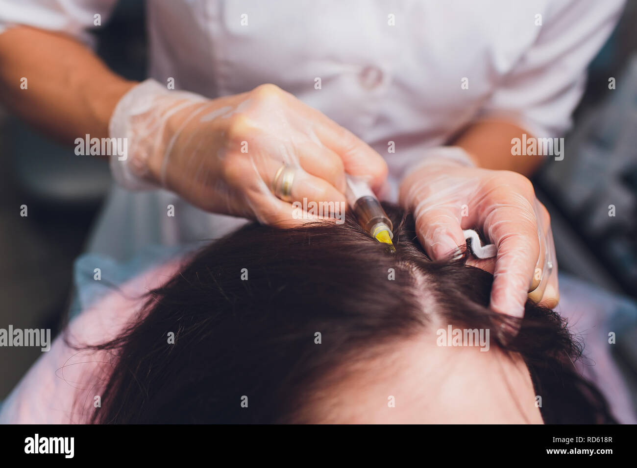 Il plasma ricco di piastrine procedura di iniezione. La crescita dei capelli stimolazione. La terapia con PRP processo. Foto Stock