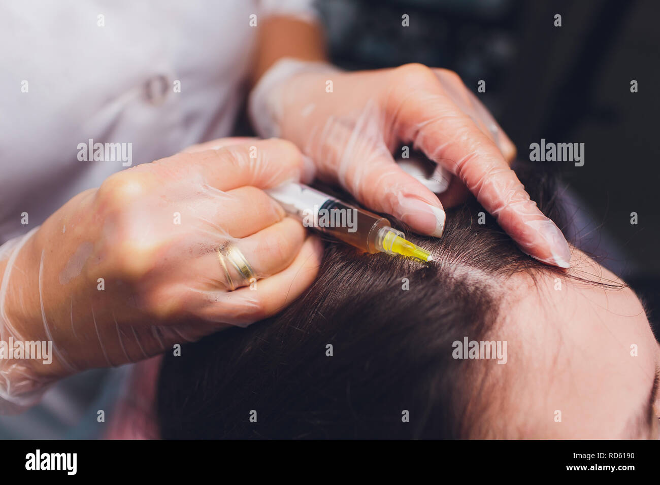 Il plasma ricco di piastrine procedura di iniezione. La crescita dei capelli stimolazione. La terapia con PRP processo. Foto Stock
