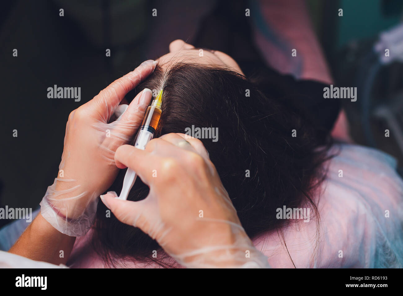 Il plasma ricco di piastrine procedura di iniezione. La crescita dei capelli stimolazione. La terapia con PRP processo. Foto Stock