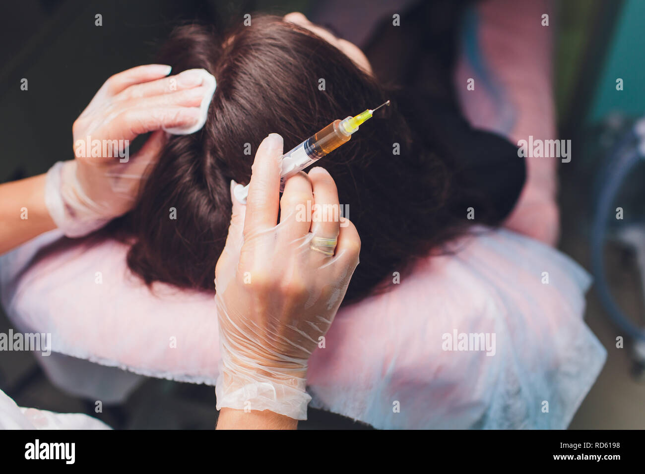 Il plasma ricco di piastrine procedura di iniezione. La crescita dei capelli stimolazione. La terapia con PRP processo. Foto Stock