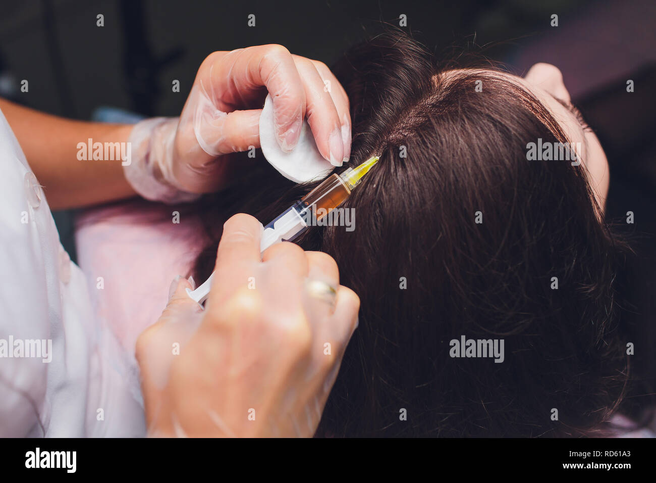 Il plasma ricco di piastrine procedura di iniezione. La crescita dei capelli stimolazione. La terapia con PRP processo. Foto Stock