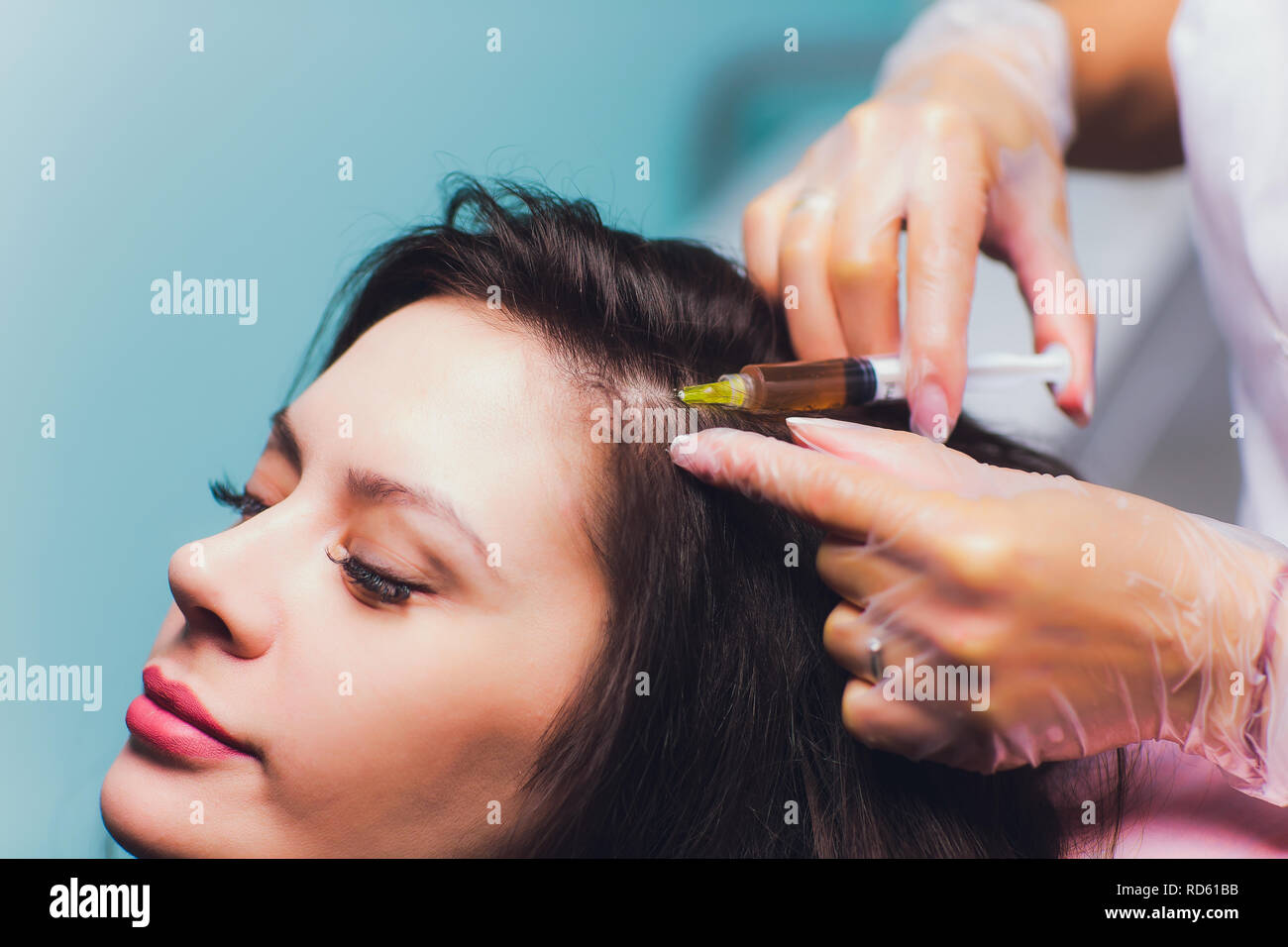 Il plasma ricco di piastrine procedura di iniezione. La crescita dei capelli stimolazione. La terapia con PRP processo. Foto Stock