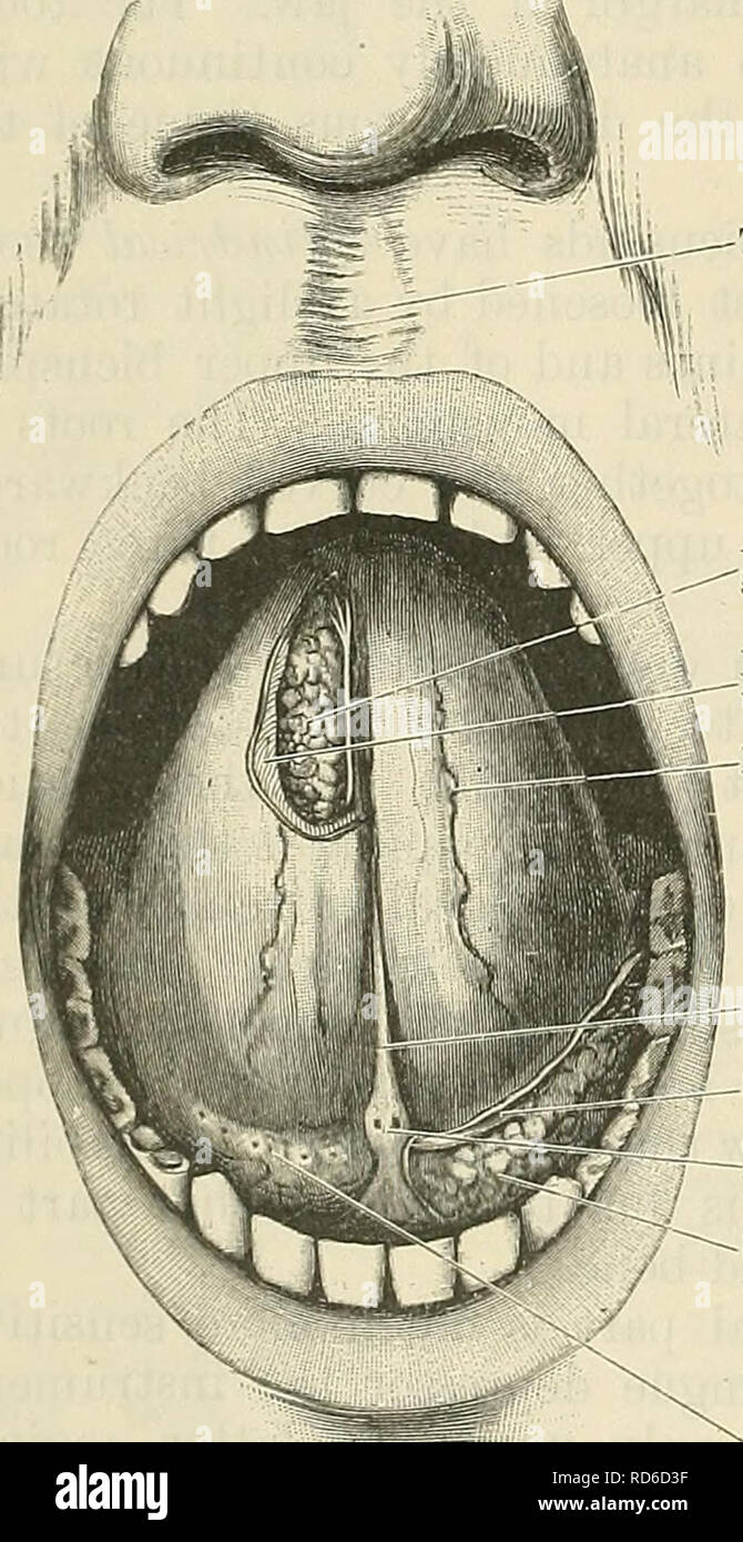 . Cunningham il libro di testo di anatomia. Anatomia. Styloglossus. Meno navi alveolare e nervose del nervo linguale esterna arteria mascellare parte superficiale della ghiandola sottomascellari" condotto sottomascellari parte profonda sottomascellari ipoglosso premistoppa tendere.  arteria linguale/^S? Hyoglossus/^ Mylo-hyoi" tendine Digastric' Genio-hyoid muscolo temporale la linguetta inferiore navi alveolare e nervose esterna arteria mascellare Mylo-hyoid nervo linguale parte profonda della ghiandola sottomascellari sottomascellari condotto v nervo ipoglosso x arteria linguale Digastric Hyoglossus Genio-liyoid Fig. 1083. -Sezione coronale attraverso la tenaglia Foto Stock