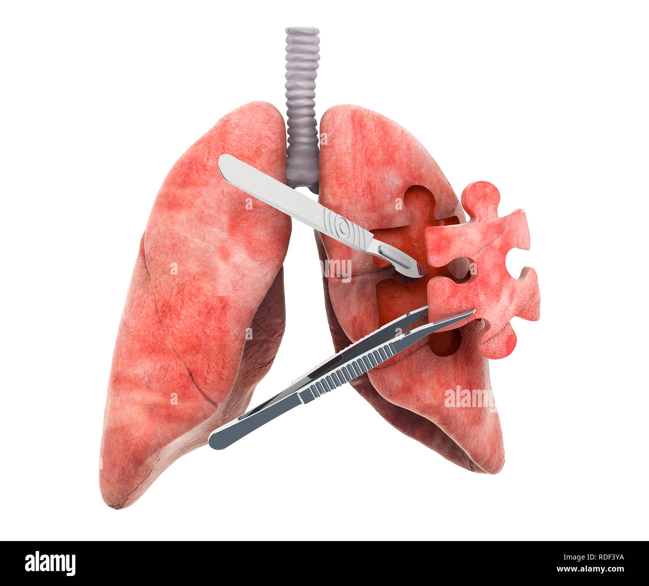 La chirurgia dei polmoni concetto, 3D rendering isolati su sfondo bianco Foto Stock