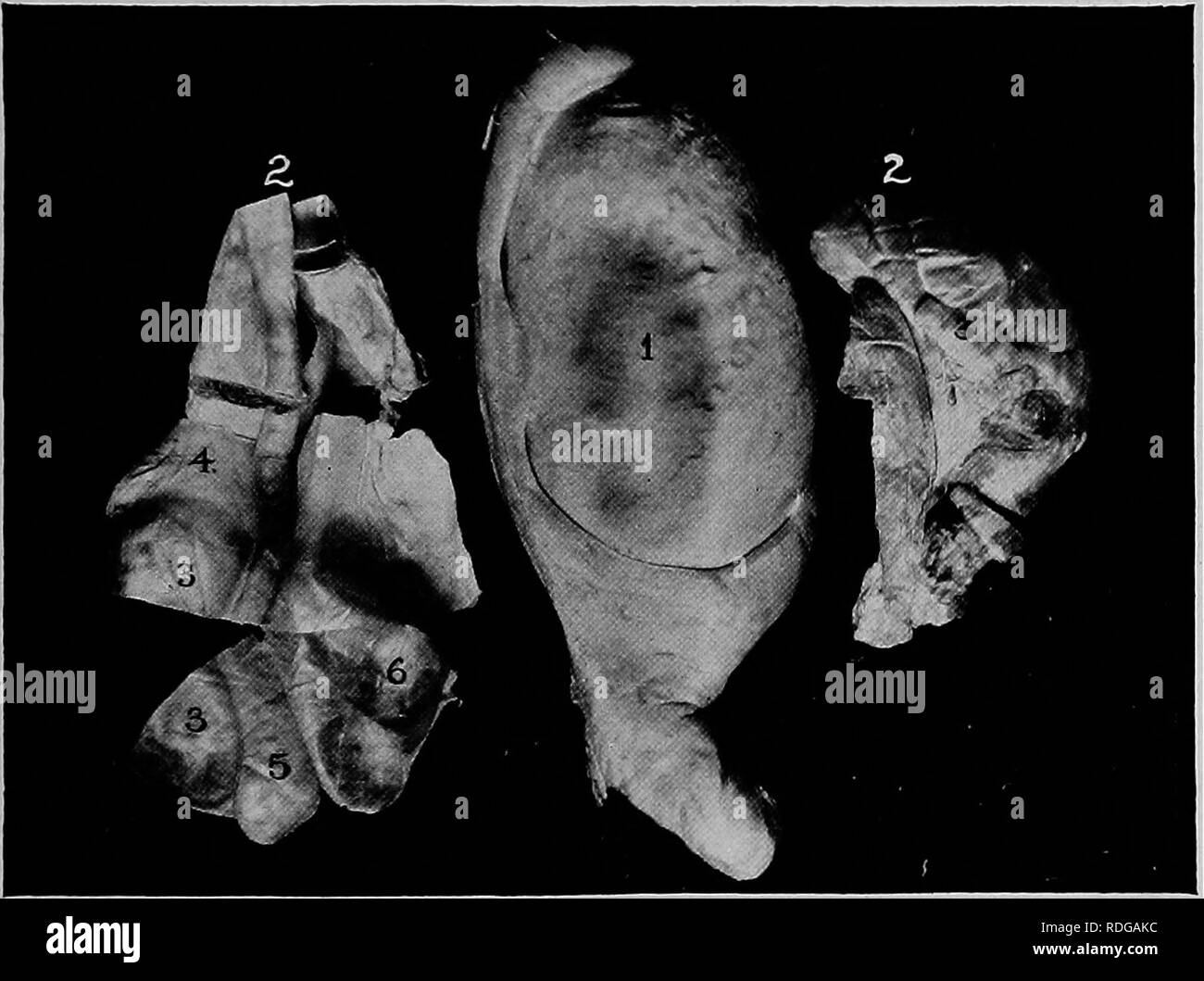 . Le malattie degli organi genitali degli animali domestici. Medicina veterinaria. Malattie degenerative Orchite di vitelli 2,11 Cryptorchid testicoli basato su arresto embryologic sono al- la maggior parte invariabilmente molto più piccolo in termini di volume che in condi- zione in discussione. Sembra molto probabile che in tutti o quasi tutti scrotale dei testicoli del tipo descritto i cambiamenti sono riconducibili ad un'invasione batterica. Il periodo di invasione sembra essere quello del vivaio. Almeno l'epoca di invasione precede la pubertà, in modo che dal primo copula-. FiG. 122-degenerative () atrofica Orchite nei giovani - Boll. /, Foto Stock