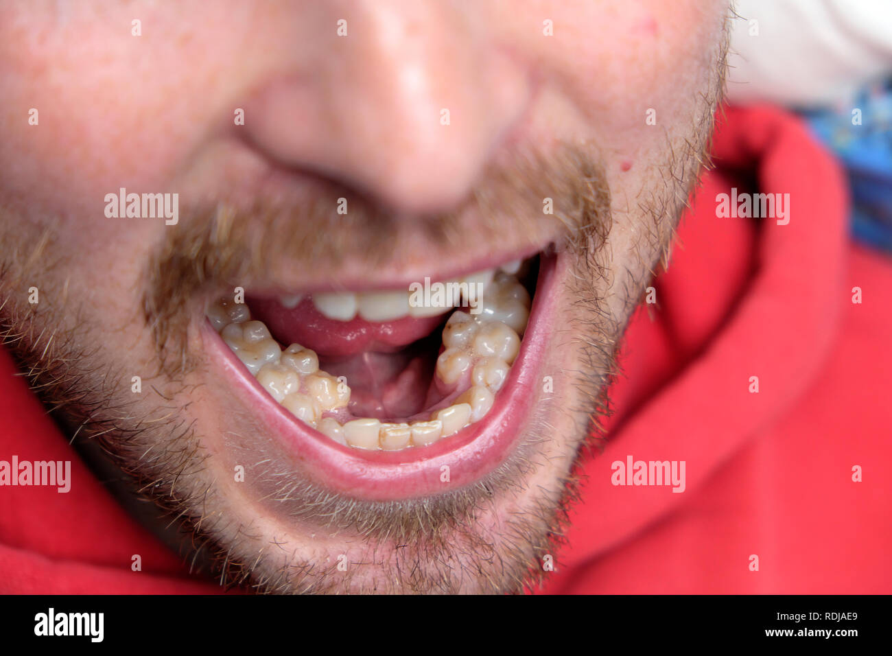 Un giovane uomo con la bocca aperta che mostra la sua serie extra di molari premolari supernumeraries denti premolari in Wales UK KATHY DEWITT Foto Stock