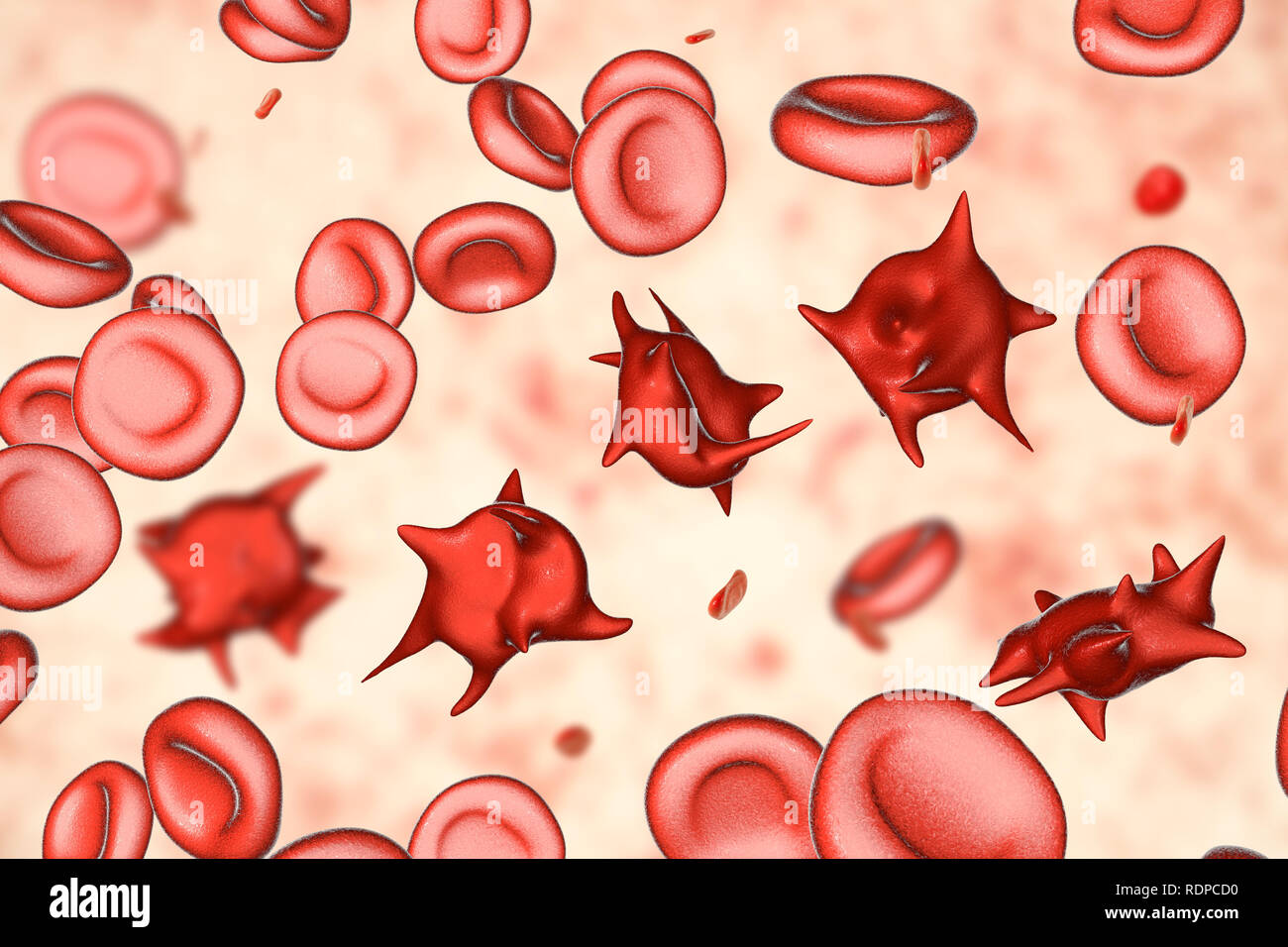 Acanthocytes. Illustrazione di una anormale cellule rosse del sangue noto come stimolare cellule o acanthocytes. Le cellule rosse del sangue con questo aspetto può verificarsi in associazione con una rara condizione chiamata abetalipoproteinemia, così come nelle malattie del fegato, Huntington acanthocytosis, ereditato diversi disturbi neurologici, anoressia nervosa, ipotiroidismo, alcolismo e altri disturbi. Le Cellule deformate sono distrutti prematuramente, principalmente nella milza, causando anemia. Foto Stock