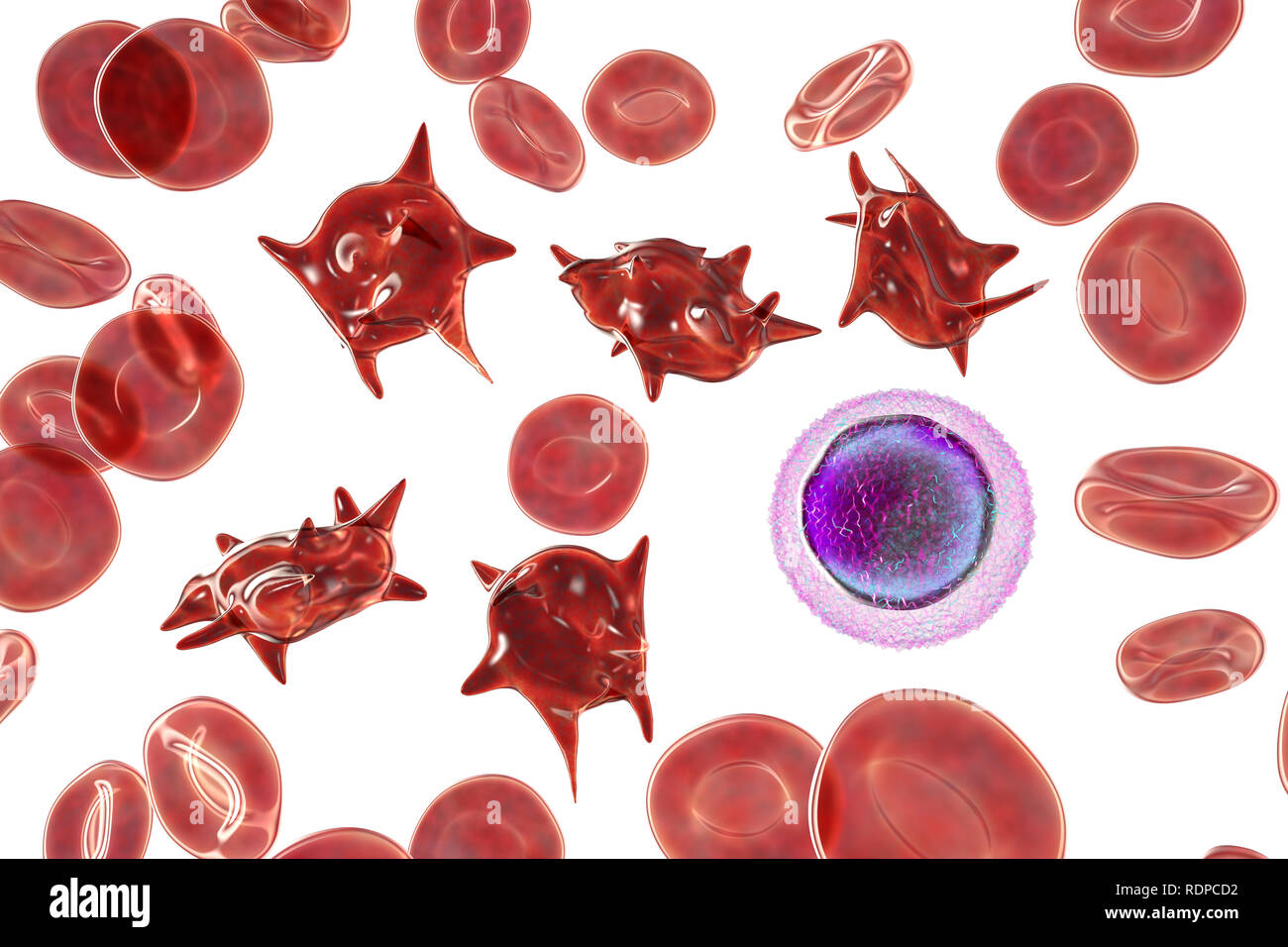 Acanthocytes. Illustrazione di una anormale cellule rosse del sangue noto come stimolare cellule o acanthocytes. Le cellule rosse del sangue con questo aspetto può verificarsi in associazione con una rara condizione chiamata abetalipoproteinemia, così come nelle malattie del fegato, Huntington acanthocytosis, ereditato diversi disturbi neurologici, anoressia nervosa, ipotiroidismo, alcolismo e altri disturbi. Le Cellule deformate sono distrutti prematuramente, principalmente nella milza, causando anemia. Un linfocita di piccole dimensioni è disegnata per il confronto delle dimensioni. Foto Stock