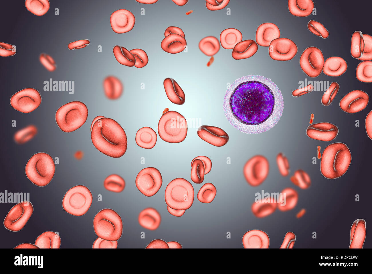 Anemia da deficienza di ferro. Computer illustrazione che mostra  hypochromic (stain scarsamente) e microcytic (piccole) le cellule rosse del  sangue. Un linfocita di piccole dimensioni è disegnata per il confronto  delle dimensioni.