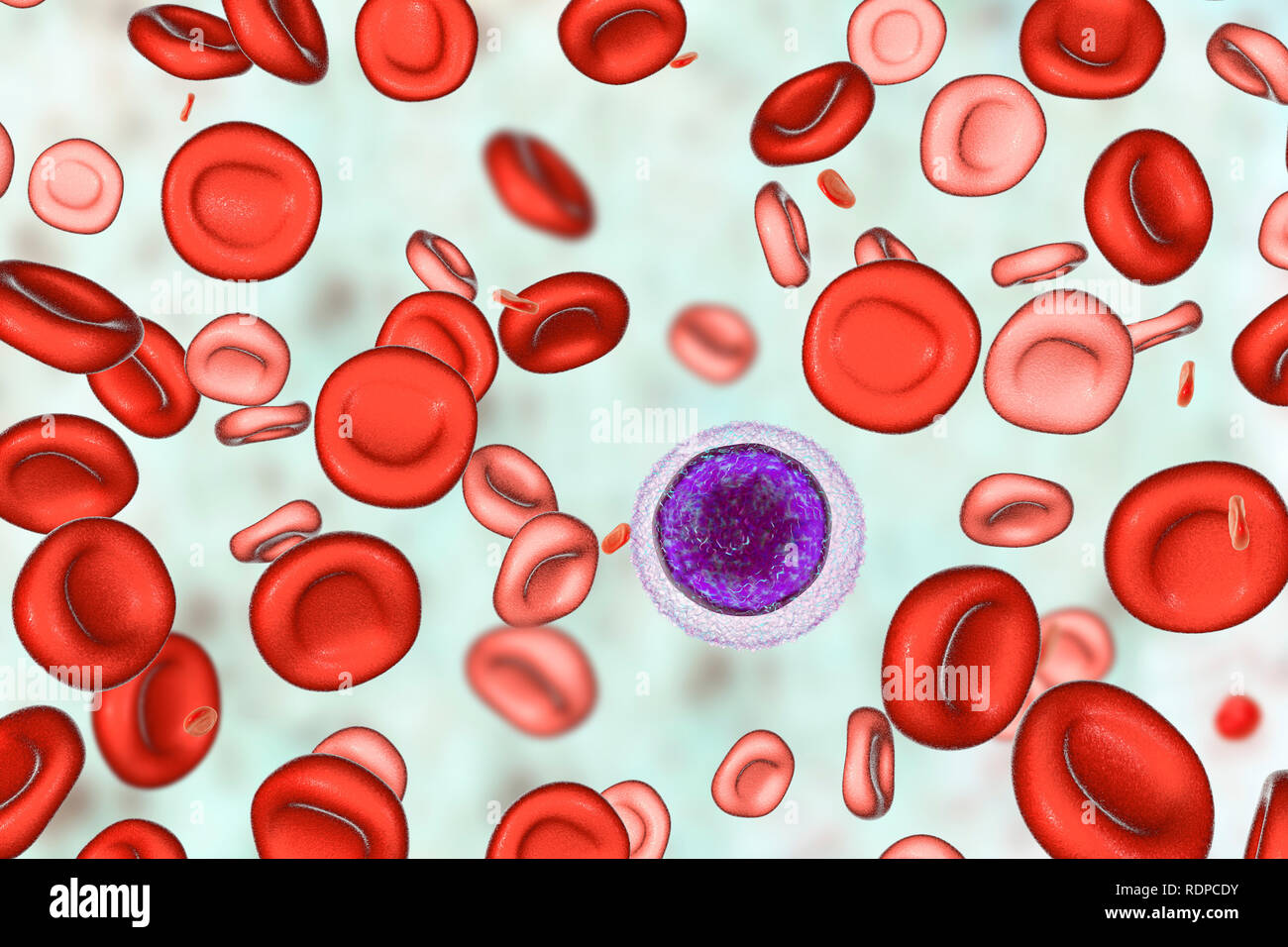 Anemia da deficienza di ferro. Computer illustrazione che mostra il sangue  di un paziente dopo hemotransfusion. Le normali cellule rosse del sangue  sono visti insieme con hypochromic (stain scarsamente) e microcytic  (piccole)