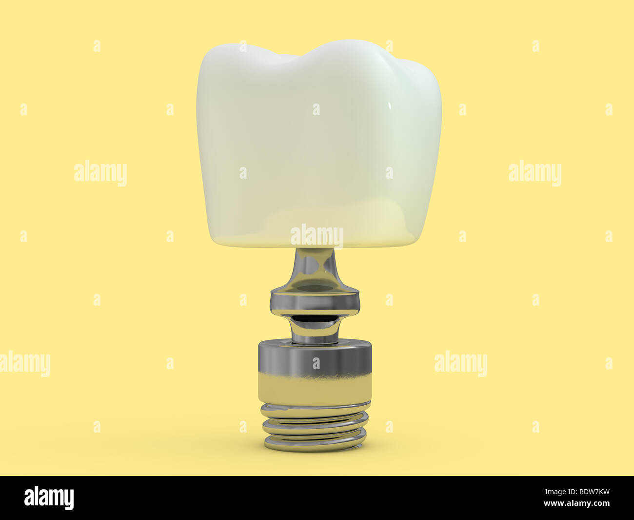 Impianto dentale dentista, dente formato, materie plastiche, uomo, trattamento dei denti 3D rendering Foto Stock