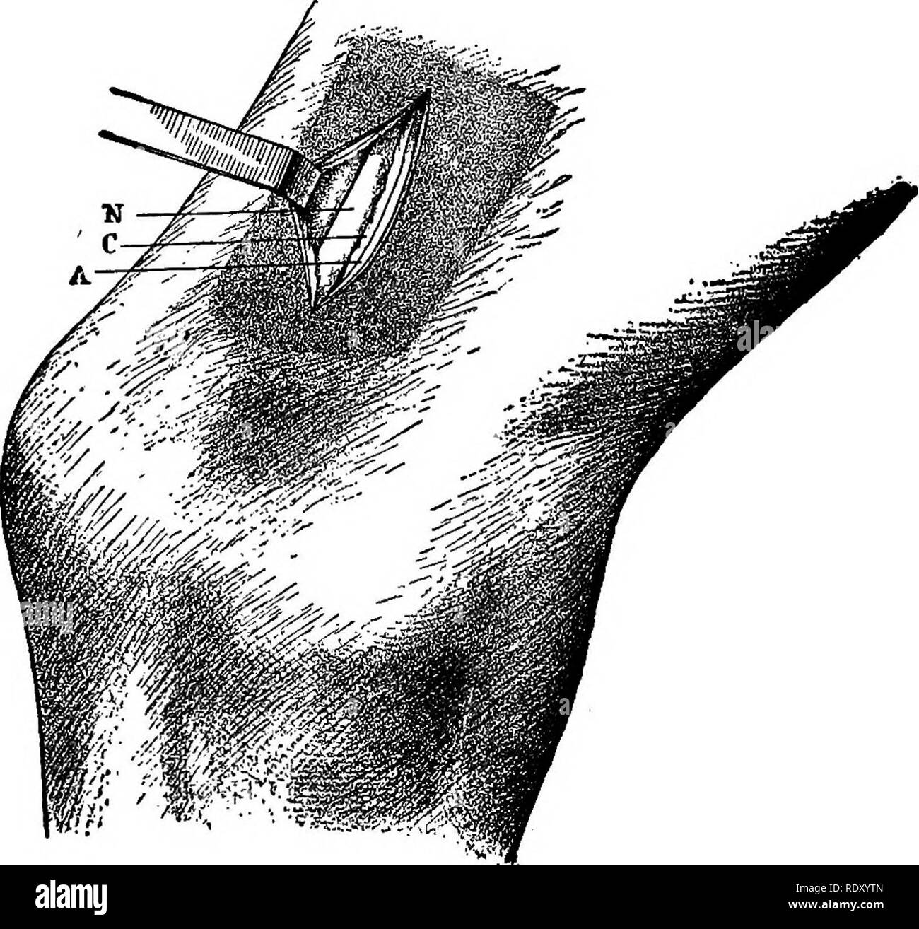 . Un trattato di terapie chirurgiche di animali domestici. Chirurgia veterinaria; Therapeutics, chirurgico. 314 VETEfetiSTARY SURGtCAL THERAtEtfTlCS. Il nervo essendo libero, è sollevato con il forcipe, un aneurisma ago o un pezzo di filo è passato per primo al di sotto di esso, e un pezzo di esso (circa 2 cen- timeters) viene amputata,-la divisione del nervo essendo realizzato prima in corrispondenza della estremità superiore della incisione. La ferita viene poi lavato con acqua bollita; i coaguli di sangue che può contenere sono puliti; i bordi della ferita sono spolverato di iodoformio o coperto con vaselina iodoformed, ha riunito wi Foto Stock