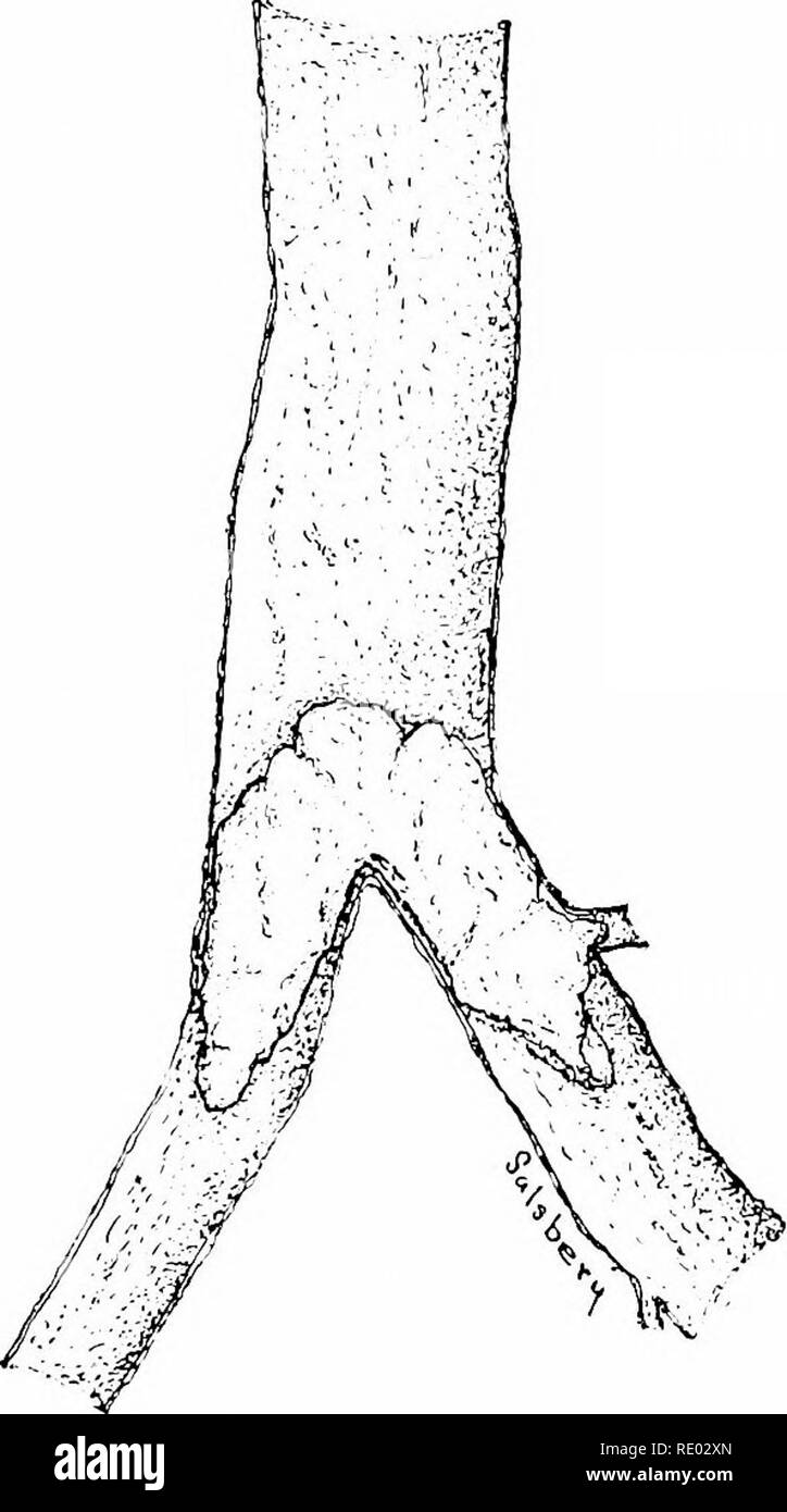 . Un libro di testo di patologia veterinaria, per studenti e professionisti. Patologia veterinaria. OISTURBANCKS circolare. 129 può diventare miscelata con il sangue e impigliarsi nelle valvole cardiache, interferendo in tal modo con cuore azione (un'hurse fu distrutta in quattro minuti bv injectino- aria nella IU-ular vem). Posizione.âEmbolism si verifica più frequentemente nelle arterie e nel portale del sistema circolatorio. "Enons emboli come una regola pass per il lato destro del cuore e nelle arterie polmonari in cui essi lodge. Frammenti di trombi da vene intestinali passano nel sistema portale e sono presentate Foto Stock