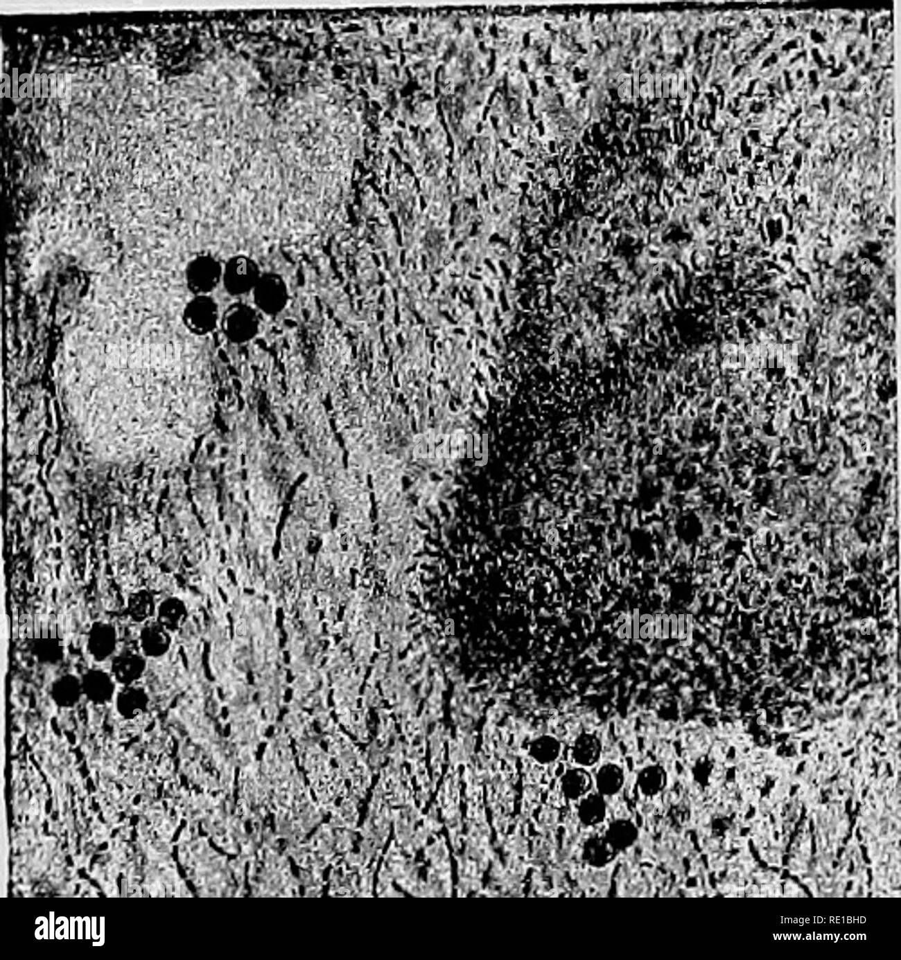 . Un libro di testo su batteri patogeni e protozoi per gli studenti di medicina e medici. Batteriologia; batteri patogeni; protozoi. 788 Mycetoma o Madura-piedi. '^K l!/J' actinomyces nella struttura. Boyce e di geometra,* dopo aver studiato diciotto casi di malattia, ha concluso che i funghi presenti pre- rappresentavano molte delle caratteristiche del fungo actinomyces. Successivamente Boycef coltivato un streptothrix, da un caso di Madura piede che differisce leggermente da funghi coltivati in precedenza. Adami e KirkpatrickJ credono che il fungo osservati da loro era identica alla actinomyces. Ho Foto Stock