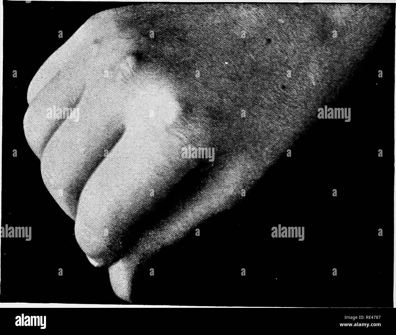 . Malattie del Metabolismo e del sangue, parassiti animali, tossicologia. Malattie costituzionali; metabolismo; sangue; medico di parassitologia; i veleni. 252 cronica reumatismo articolare dà le seguenti statistiche del suo caso. Nelle forme inizio acuto, vi erano il 53,4 per cento, del cuore mormora e venti per cento di malattia valvolare; in casi di malattie croniche sin dall'inizio solo 13,5 per cento, del cuore mormora e il 4 per cento della malattia valvolare. Nefrite cronica di carattere benigno e mostrando ma lieve tendenza a uremia è non di rado osservati. Tra le altre complicazioni quelle che colpiscono th Foto Stock