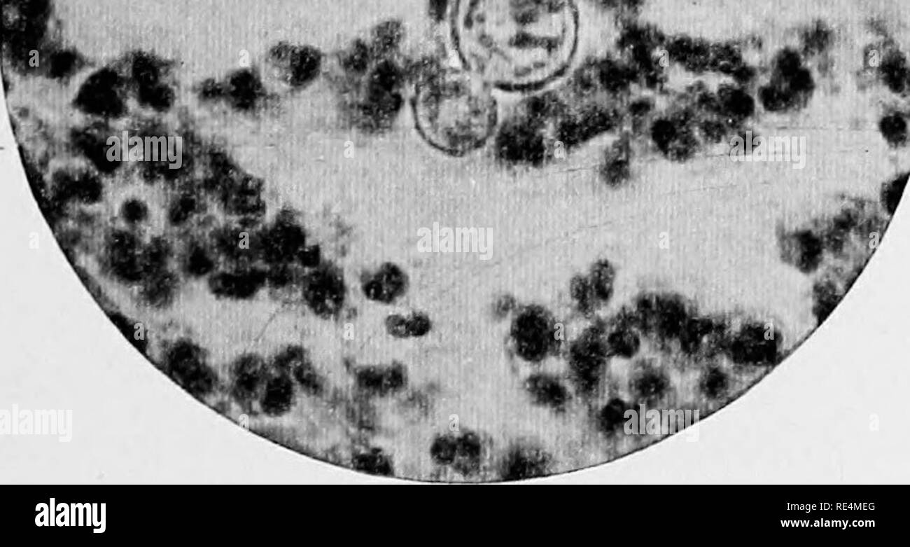 . Manuale di batteriologia. Batteriologia. Fig. 62. - Blastomyces dermatitidis (Gilchrist): sec- tion tlirough un ascesso cavità sliowin^ l'organismo con doppiamente-sagomato di membrana X looo. [Dal tipo di per- missione del dottor T. Caspar Gilchrist.] Buddins. Fig. 63. - Blastomyces dermatitidis (Gilchrist): visualizza ing erba sotto forma di organismo salone in presenza di pus di un ascesso la cavità X looo. [Per gentile concessione del dott.ssa T. Caspar Gilchrist.] moduli (Fig. 63), che assomigliano a quelle delle normali cellule di lievito, sono spesso incontrato, e sembra come se fossero in erba il consueto metodo di riproduzione; alcuni ce Foto Stock