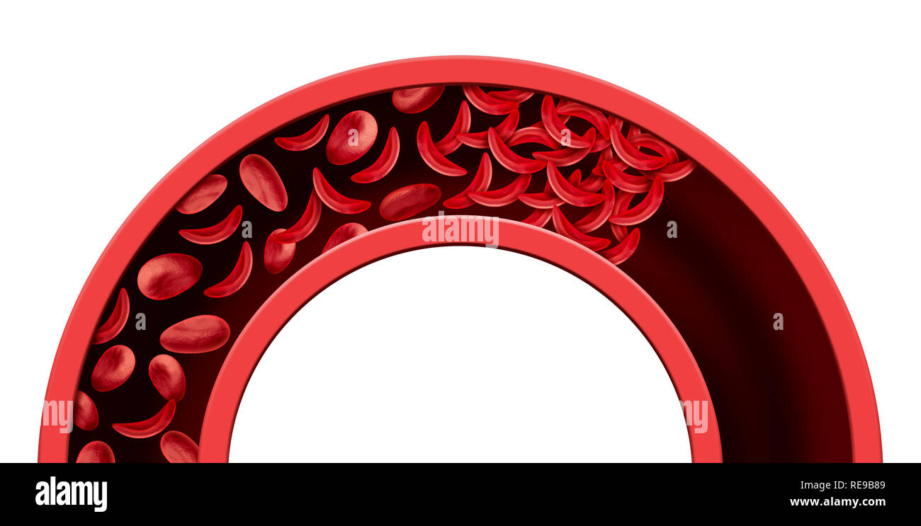 Cella di falce il blocco dei vasi sanguigni e anemia come una malattia con normale e di emoglobina anormale con un'arteria ostruita o vena anatomia. Foto Stock