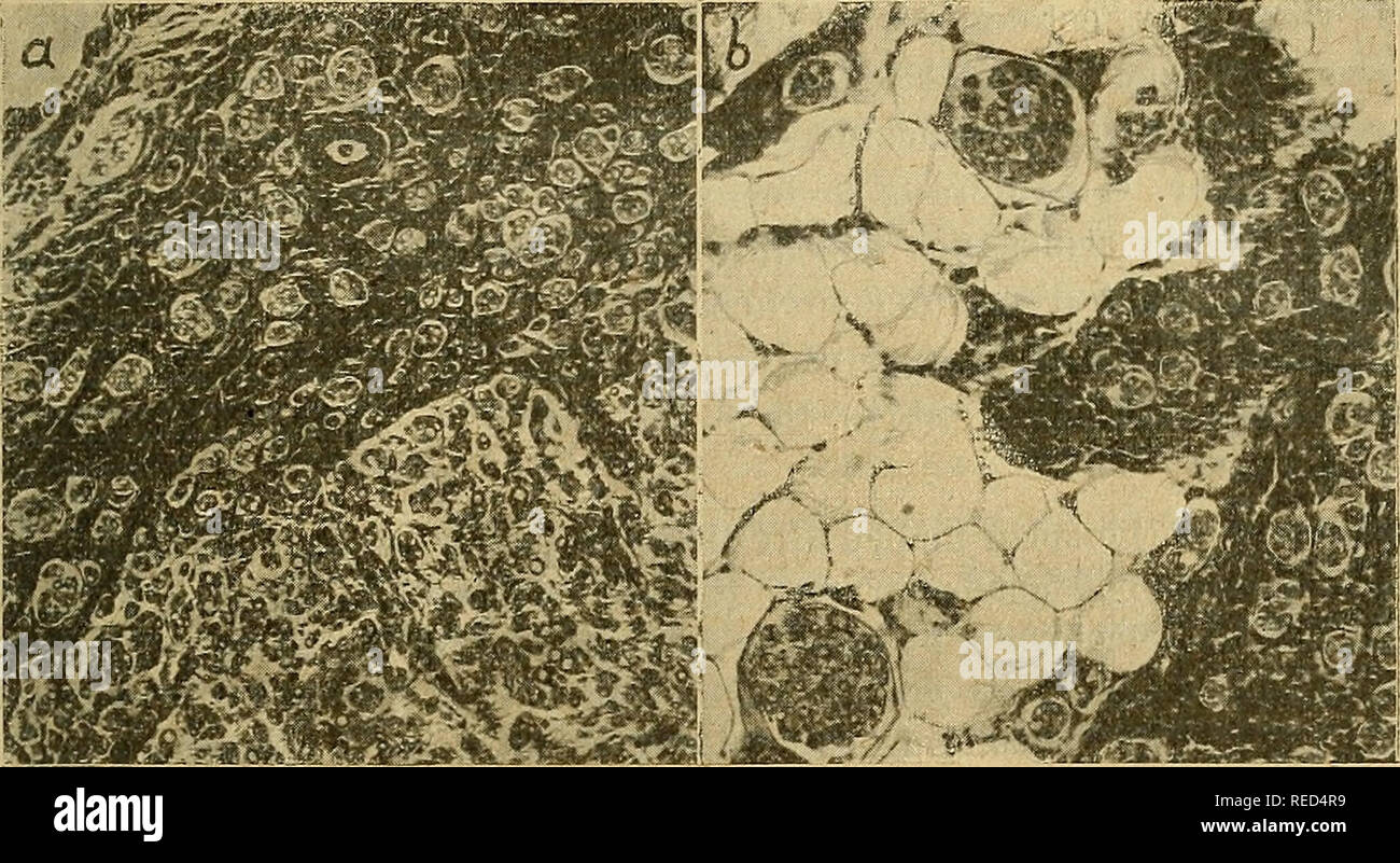 . Comptes rendus des sÃ©ances de la SociÃ©tÃ© de Biologie et de ses filiales. Biologia. SÃANCE DU 3 juin 481 onu tritare tractus blanchÃ¢tre; le tissu conjonctif un partout repris sa souplesse normale: il n'existe plus aucune adhÃ©renza du nerf recon- stituÃ© aux voisines parti. Les muscoli antÃ©ro-externes de la jambe gauche sont normaux comme volume et comme couleur, tandis qu'Ã droite, ou le sciatique avait Ã©tÃ© arrachÃ©, les mÃªmes muscoli sont com- plÃ¨tement atrophiÃ©s. La cicatrice nerveuse avait donc donnÃ© de bons rÃ©sultats au point de vue fonctionnel. La ricostruzione longitudinale d Foto Stock