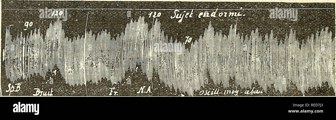 . Comptes rendus des sÃ©ances de la SociÃ©tÃ© de Biologie et de ses filiales. Biologia. 962 SOCIKIB IIK BI(Â"I.(Â"GIK Tout au contraire, le sphygmomanomÃ¨tre (brachiale brassard grandi), ã peine inlluencÃ© parle changement de calibro des vaisseaux cutanÃ©s de la rÃ©gion [qui ne costituente qu'onu dÃ©partement plus importante par rapport à la masse vas- culaire des muscoli du bras], donne l'indicazione de FelTet presseur artÃ©riel gÃ©nÃ©ral qui rÃ©sulte d'une vaso costrizione-Ã©tendue à la totalitÃ© des tÃ©gu- zioni et à d'autres dÃ©partements profonds. C'est ce que montre la figura ci-jointe fourni Foto Stock