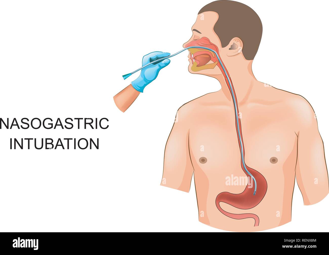 Illustrazione vettoriale del sondino nasogastrico intubazione. Il tubo nello stomaco Illustrazione Vettoriale