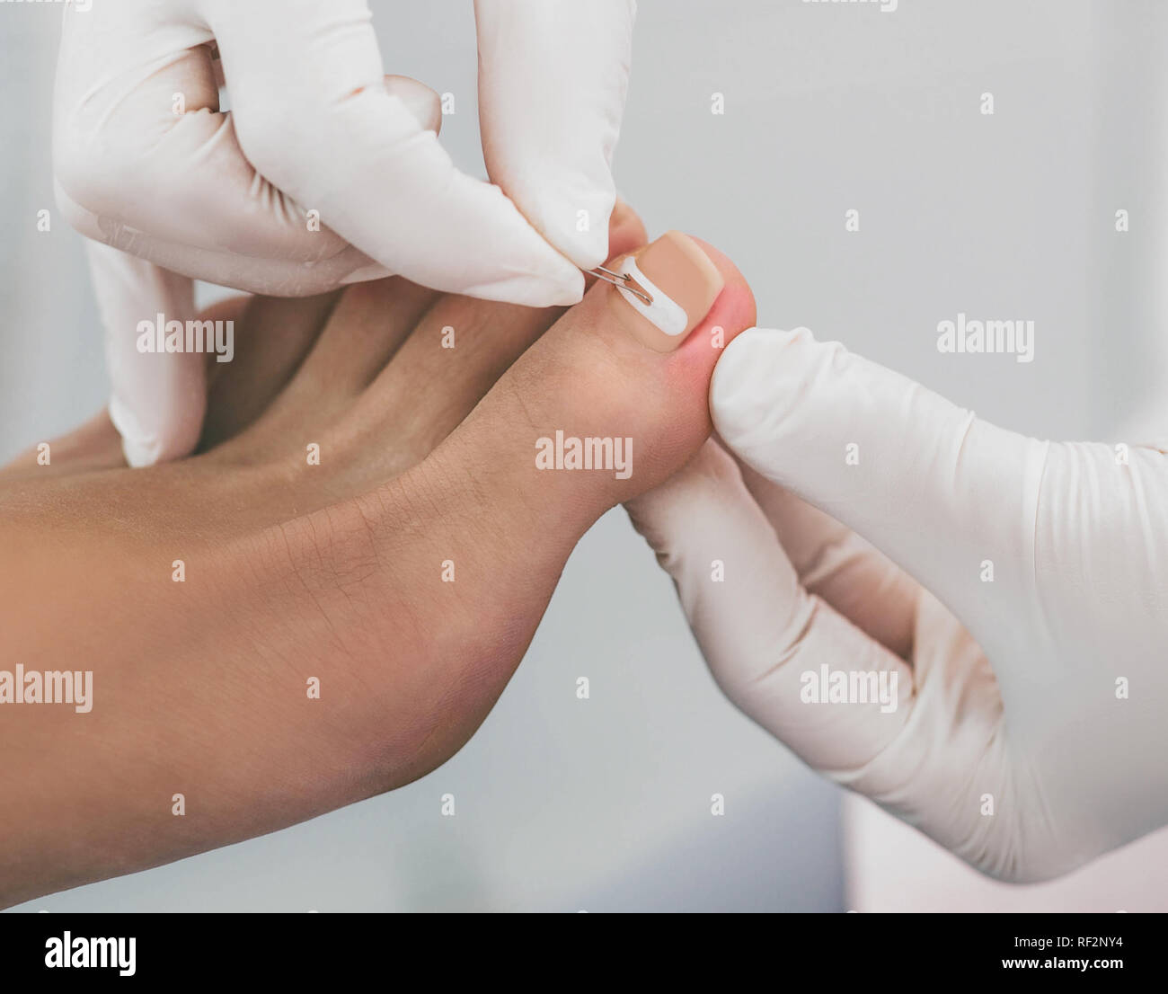 Podologia medico considera chiodo incarniti. onychocryptosis, malattia delle unghie Foto Stock