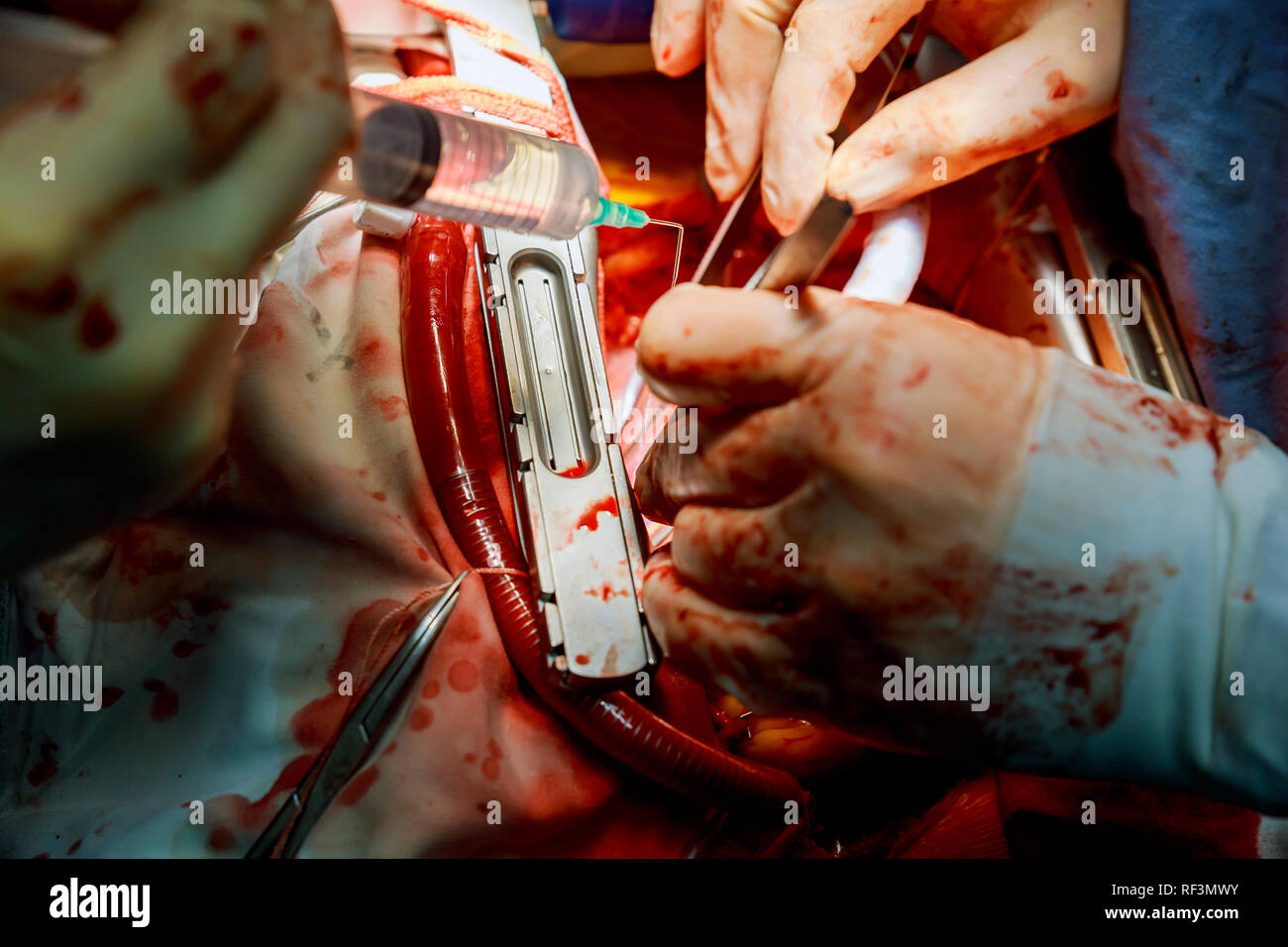 Il chirurgo esegue una operazione chirurgo in sala operatoria con maschera di sangue Foto Stock