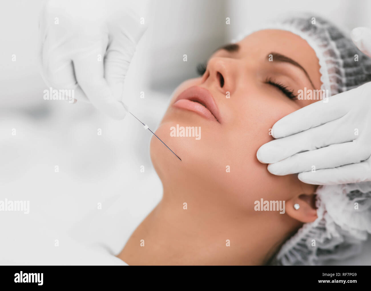 Estetica chirurgia viso,tecnica cosmetica, mesothreads sollevamento e faccia di contornazione Foto Stock