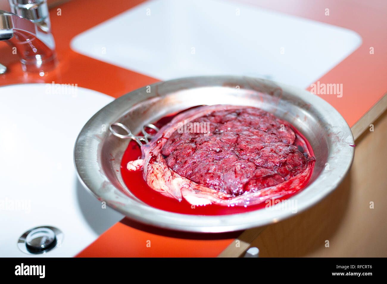 La placenta umana con cordone ombelicale e forbici chirurgiche su una piastra di metallo accanto a un lavandino. Foto Stock