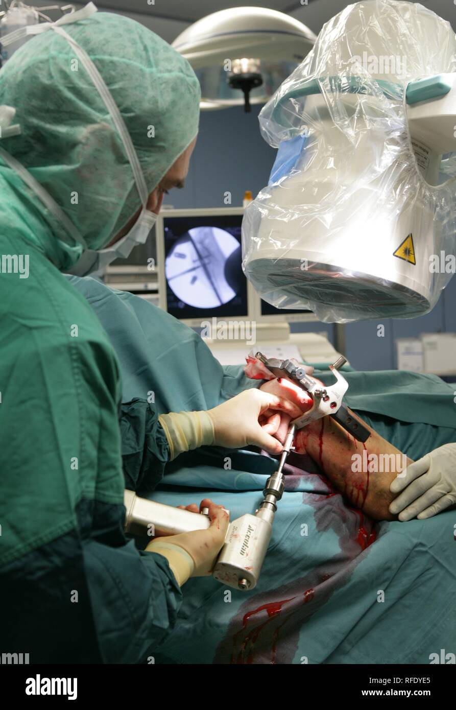 La chirurgia di una spalla, strumento controllo del corretto fissaggio di osso-vite Foto Stock
