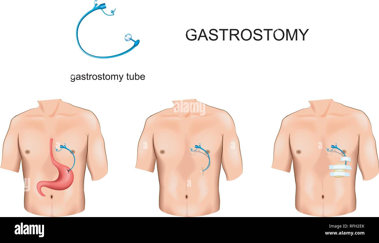 Illustrazione vettoriale di gastrostomia tubo con ostruzione esofagea Illustrazione Vettoriale